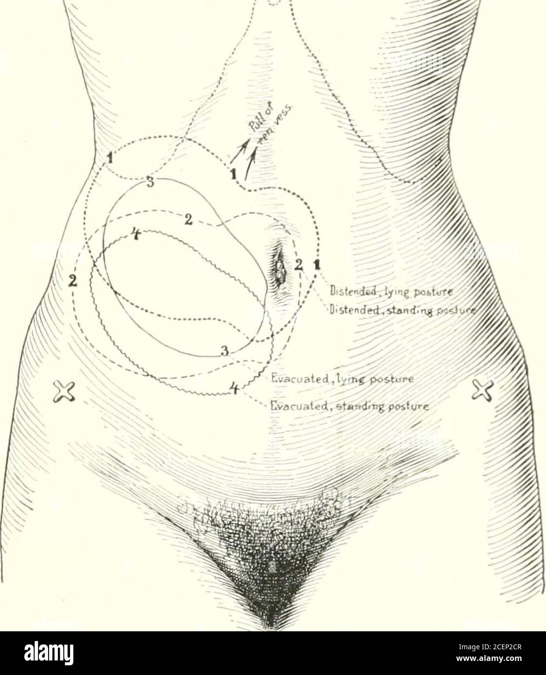 . Erkrankungen der Nieren, Harnleiter und Blase, mit besonderem Bezug auf die Erkrankungen der Frauen. Und Hnally das tubu-lar-System des Parenchyms, bis zum Glomerulus. Die fortschreitenden degenerativechanges wdiich treten im Paren-Chyma der Niere auf und sind in den Studien von Max Broc-del dargestellt und in Abbildung 203 dargestellt. Eine aus dieser Studienserie hervorgegange Entzündung, die das erste Stadium der Krankheit auf Druck aus dem Pel-vis, der die Papillarhöhung abflacht, die Kanäle zusammendrückt und somit die Harnsektion stört, zurückzuführen ist. Aufgrund der Nähe von Nder Stockfoto
