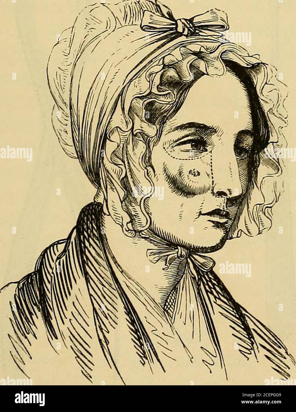 . Verletzungen und Krankheiten der Kiefer : der Jacksonian Preis Essay des Royal College of Surgeons of England, 1867. Ist besser, nach dem Prinzip zu handeln, das Operationsupon cancerous growths in anderen Teilen des Körpers führt - zu OPERATIONEN AM OBERKIEFER. 319 Entfernen Sie die Wucherungen, wenn möglich, in der Hoffnung, dass atleast Erleichterung, wenn nicht eine dauerhafte Heilung. Syme, Mott, Velpeau, Dieffenbach, Oshaughnessy, Hey-felder, Fergusson, und Metzger kann erwähnt werden, wie havingperformed die Operation der Exzision der überlegenen maxillareatedly und erfolgreich, und Sir William Fergussonbesonders ist aufgrund t Stockfoto