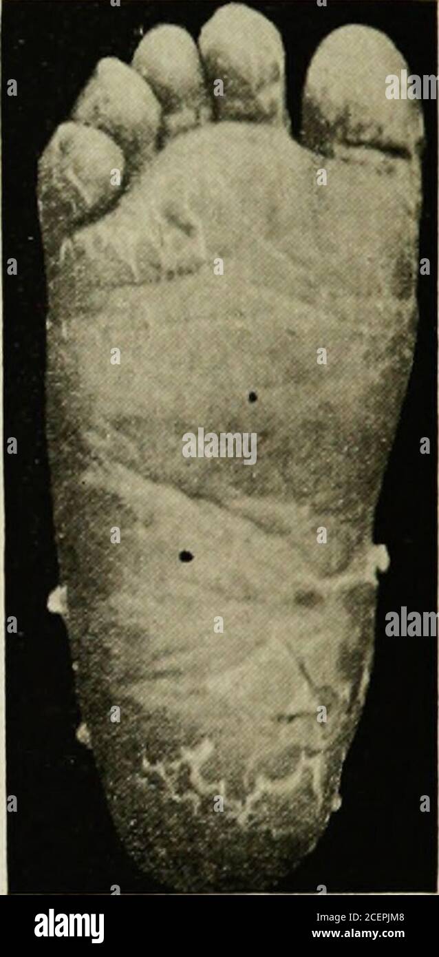 . Die Krankheiten der Kindheit und Kindheit. Abb. 182. – früher Ausbruch des HereditarySyphilis. Kleinkind zweieinhalb Monate verkauft. Abb. 183. – Syphilitische Skalierung des Foot. Von einem Säugling acht Wochen alt. Coryza kann abwesend oder so gering sein, dass der Ausschlag das erste Symptom zu sein scheint. Gelegentlich wird eine diffuse Errötung oder Roseola gesehen, aber normalerweise ist der Ausbruch makulär, in kleinen, dunkelroten Flecken um die Größe der Fingernägel des Säuglings, in der Regel kreisförmig und oft leicht erhöht auftreten; es gibt keine umliegenden Entzündungen und kein Juckreiz. Es ist in der Regel mostreichlich über die Mitte des Gesichts, t Stockfoto