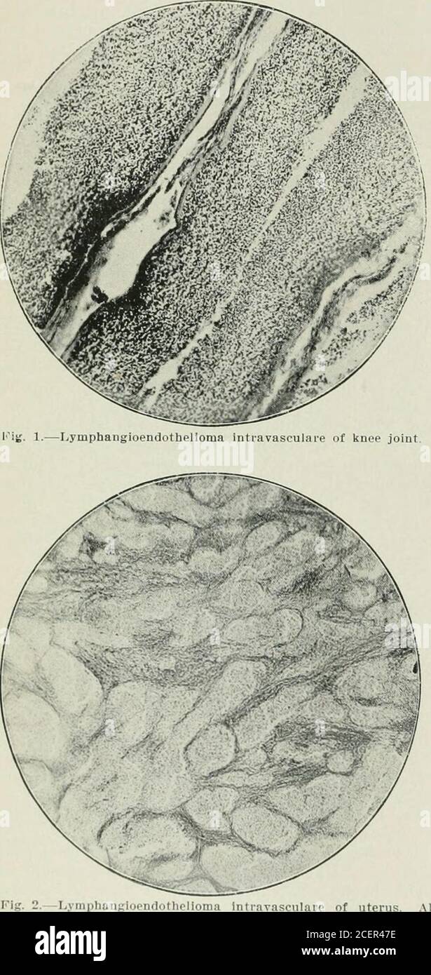 . Journal American Medical Association. 568 ENDOTHELIALE TUMOREN