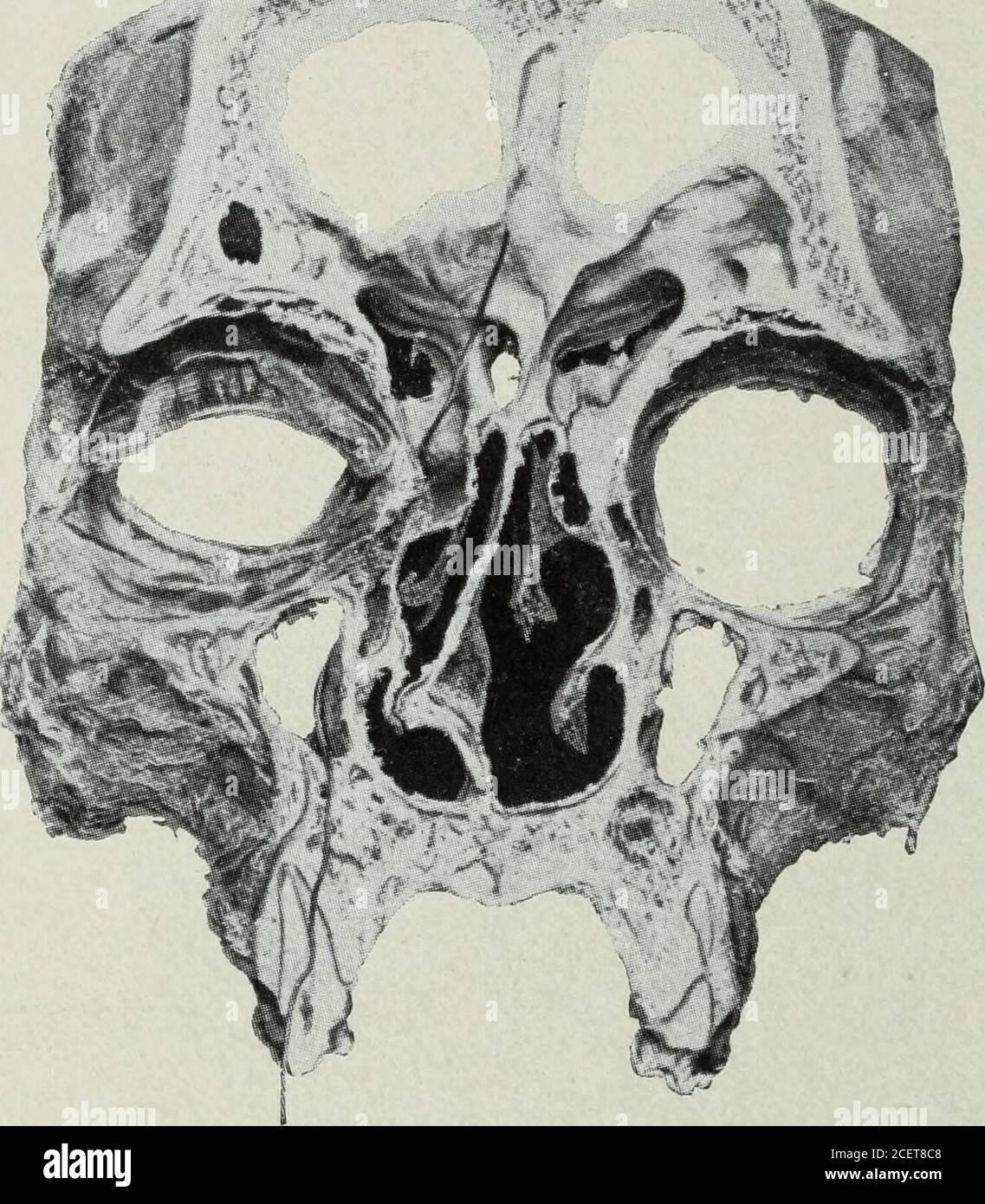 . Der Dental-Kosmos. 512 DER ZAHNKOSMOS. Struktur- und Funktionsschiff in den zugehörigen Strukturen ist selbstverständlich. Zum Beispiel in Abb. 2 eine rücksichtsvolle Überlegung im anatomischen Bereich wird gezeigt. Beobachten Sie den engen und hohen Oberkieferbogen und, in den oberen Meati, eine schwere Behinderung der Nasenatmung auf einer Seite, verursacht durch die Ablenkung der Nasenscheidewand, auch die kleinen antralen Nebenhöhlen, was auf eine nachlassende volle Entwicklung hinweist. Auch die orbitalen TYPUSVARIATIONEN UND PRÄDISPOSITIONEN. Wenn wir weiter einige dieser anatomischen Variationen des inter-nalen Gesichts mit r betrachten Stockfoto