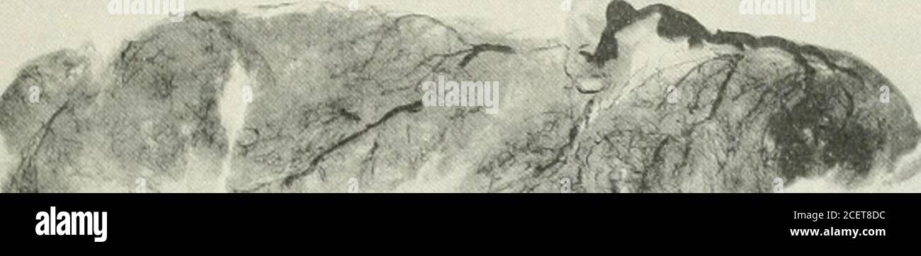 . Amerikanische Zeitschrift für Geburtshilfe und Gynäkologie. Abb. 5. – mehrere Abschnitte der gleichen Plazenta, die die verschiedenen Stadien der in-farction zeigen. Die Verdickung der feinen cotyledonösen Gefäße mit einem Verlust der üblichen wrorled Anordnung ist deutlich dargestellt. 1^ ?it • - Abb. 6. – arterielle Injektion einer Plazenta zur Zeit eines gesunden Kindes. Eine breite.&lt;ipreadseneszenz ist in der Unregelmäßigkeit der großen Oberflächenstämme, dem Trie-Strippen ihrer vielen Äste und einer großen Verminderung der Anzahl der feinen cotyledonous vesels sichtbar. Die Ränder der Plazenta sind fast ihrer Zirkulation beraubt. FKA Stockfoto