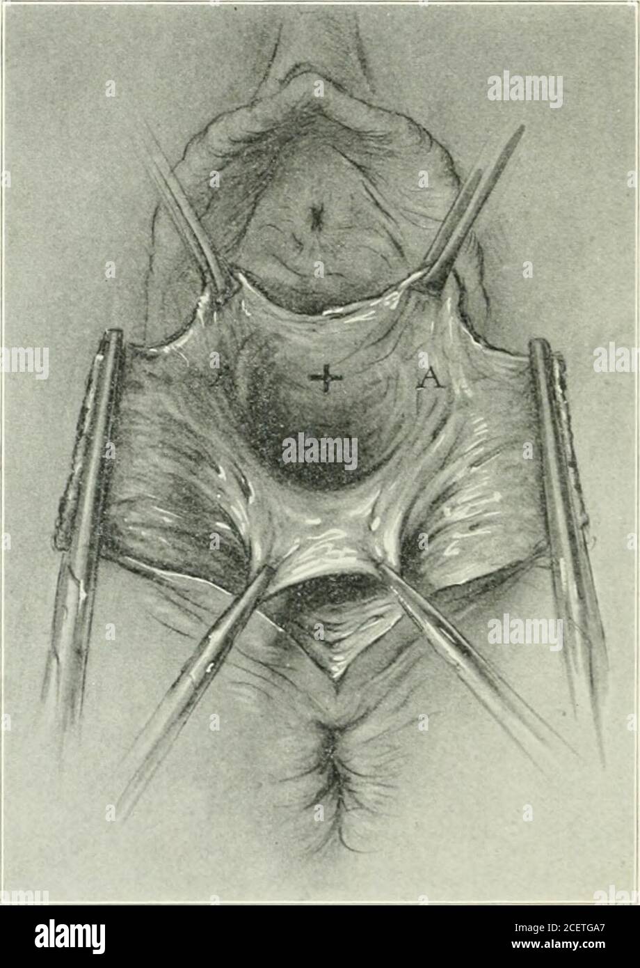 . Amerikanische Zeitschrift für Geburtshilfe und Gynäkologie. -herniale Öffnung in rrclor.-lr eine in cystoeele gefunden. BJ Mittel dieser Dissektion haben wir befähigen, die Natur der faszialen Rente zu skizzieren und haben festgestellt, dass thefascia wird aus dem Gebärmutterhals und breiten Bändern viel wie es in Fällen von cystoeele. Während der Wehen ist die Spannung iipon dieser Faszie theresult der Verschiebung des Perineums unter den Pubes und die zehn-sion ist folglich längs und das Ergebnis ist ein transversaler Riss.Wenn die rectocele gründlich seziert ist es leicht, um 396 DIE AMERICAX JOrRXAL VON GEBURTSHILFE UND GYN abzuschätzen Stockfoto