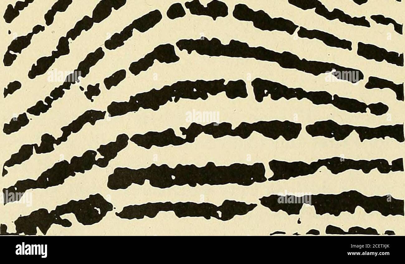 . Persönliche Identifizierung; Methoden zur Identifizierung von lebenden oder toten Personen. Abbildung 138 die in Abbildung 136 markierte quadratische Fläche, vergrößert auf 11 Durchmesser. Abbildung 139. Die in Abbildung 137 markierte quadratische Fläche, vergrößert auf 11 Durchmesser. Keine zwei identischen Fingerprints 331 Wenn man nun zu den Details kommt, machen die Autoren nicht auf den gesamten Bereich der Drucke aufmerksam, sondern auf einen ganz begrenzten Teil davon – den Teil, der vom Quadrat begrenzt ist, das jeweils das Delta einschließt. Obwohl die Drucke für allgemeine Ähnlichkeit ausgewählt wurden, wurden besondere Schmerzen ausgewählt, um auch Drucke mit s auszuwählen Stockfoto