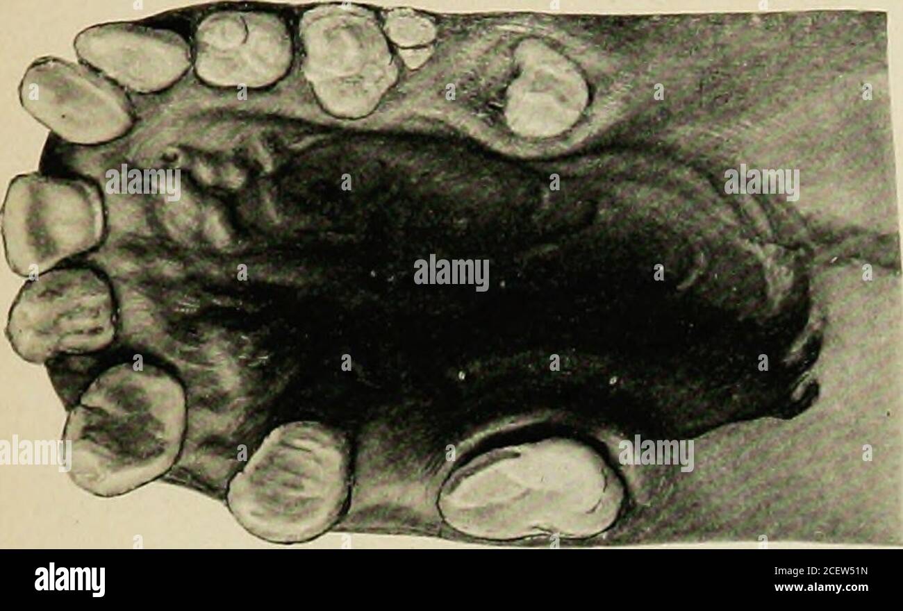 Torus palatinus Fotos und Bildmaterial in hoher Auflösung Alamy