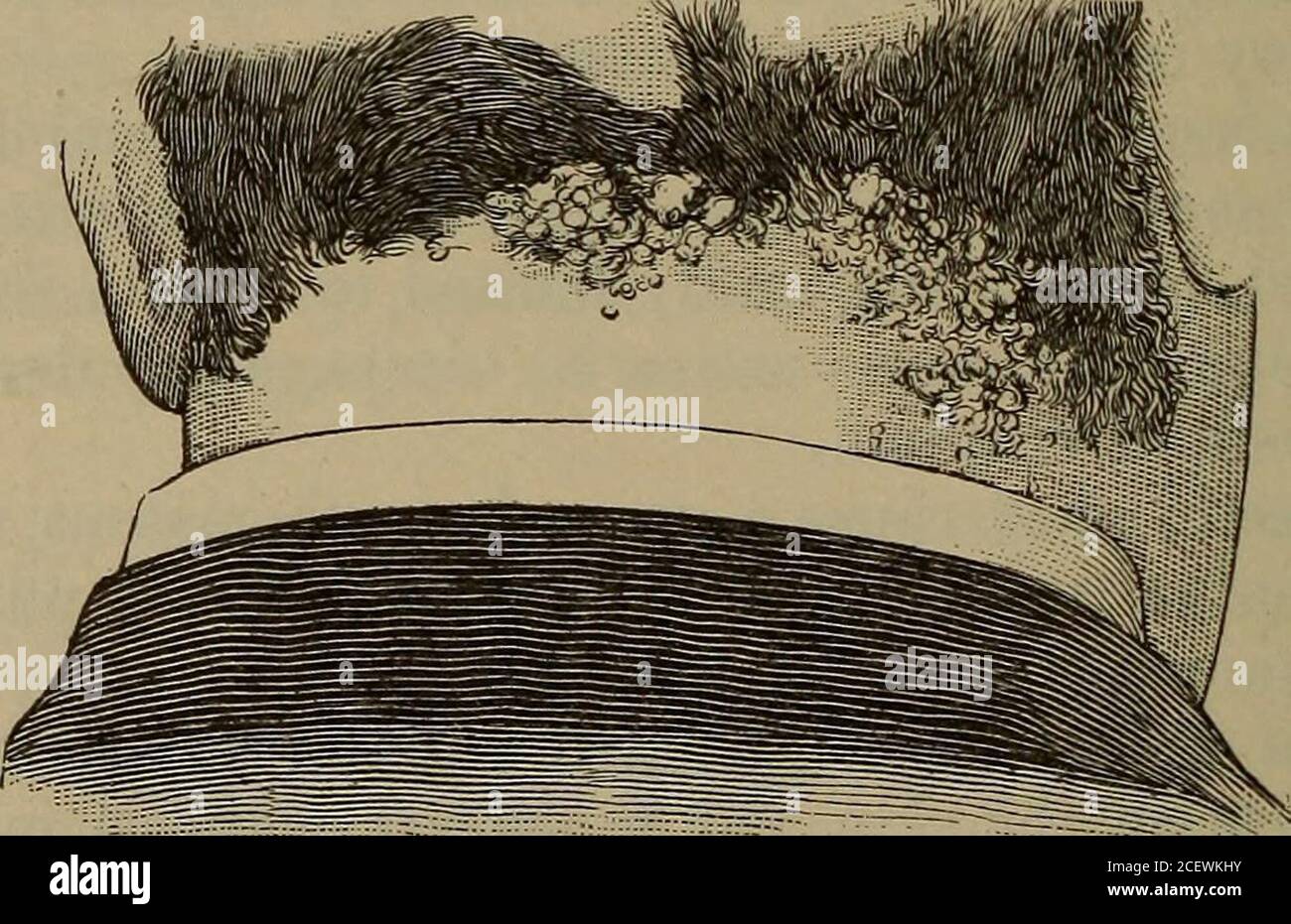 . Das fertige Handbuch von Erkrankungen der Haut. Tikaria oder eine Bläschenausbruch. Stramonium führt zu einem Juckreiz oder einem brennenden Scarlati-Noid-Erythem, einer Petechial-Eruption oder einer erysipelatoidinflammation. Strichnine kann einen Scarlatiniformen Ausschlag verursachen. Sulphonal erzeugt ein scharlatiniformes Erythema. Schwefel verursacht dunkle Verfärbungen der Haut und anekzematöse, pustuläre, furuncular, oder papuläre Exanthem. Tuberkulin kann Scarlatiniform oder Masern-Likepatches des Erythems sowie einen psoriasiformen Ausbruch verursachen. Der Tansy hat einen varioliformen Ausbruch verursacht. Terpentin und Terebene können Narben verursachen Stockfoto