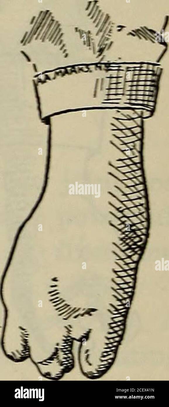 . Eine Abhandlung über künstliche Gliedmaßen mit Gummihänden und Füßen ... Nr. 1065. Nr. 1066. Nr. 1067. Nr. 1068. Die Finger wurden mit einem Sockel kombiniert, der die Metacarpalregion umhüllte. Cut No. 1064 stellt eine Handverformung dar, der Daumen und drei Fingerabwesend, der kleine Finger vorhanden, der eine unzureichende Festigkeit besaß, um vorhanden zu sein; er wurde gegen die Hand gedrückt und wie eine am-putation behandelt. Nr. 1047 Gummihand wurde aufgetragen. Schnitt Nr. 1065 stellt eine Deformität dar, die Hand, die mit Daumen endet, die normale Bedingungen besitzt. Eine künstliche Hand wurde modelliertund auf diesen Fall aufgetragen; sie wurde mitgeliefert Stockfoto