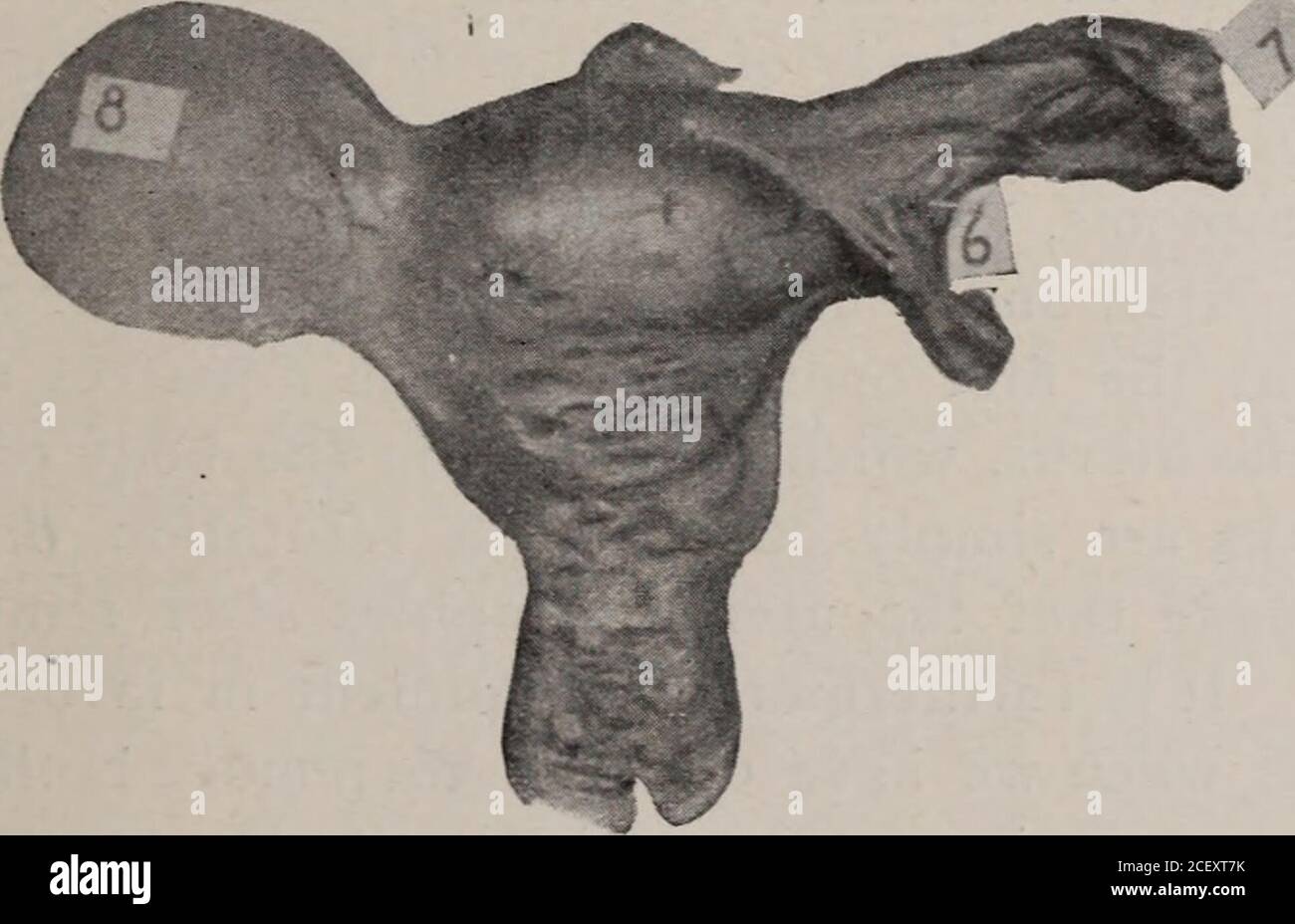 . Amerikanische gynäkologische und geburtshilfliche Zeitschrift.. Myom des Uterus nach doppelter Salpingo-Oophorektomie. (Siehe Seite 61.)Abb.1-(2) Tumor in Douglas Pouch ; (3) der gegenüberliegende Stumpf ; (4) der Fundus ; (5) der Gebärmutterhals.. Myom des Uterus nach doppelter Salpingo-Oophorektomie. (Siehe Seite 61^Abb. 2. - Vorderansicht des Uterus; (6) Ligatur auf der linken Seite; (8) Tumor am rechten Horn. Die Mesenterie war die Ursache der deprimierten Herztätigkeit in thesetw2 Fällen. Dr. J. A. Lyons : Herr Präsident, ich möchte nur ein Wort oder zwei in Bezug auf den großen Tumor von Dr. Binkley entfernt sagen. Ich hatte die pl Stockfoto