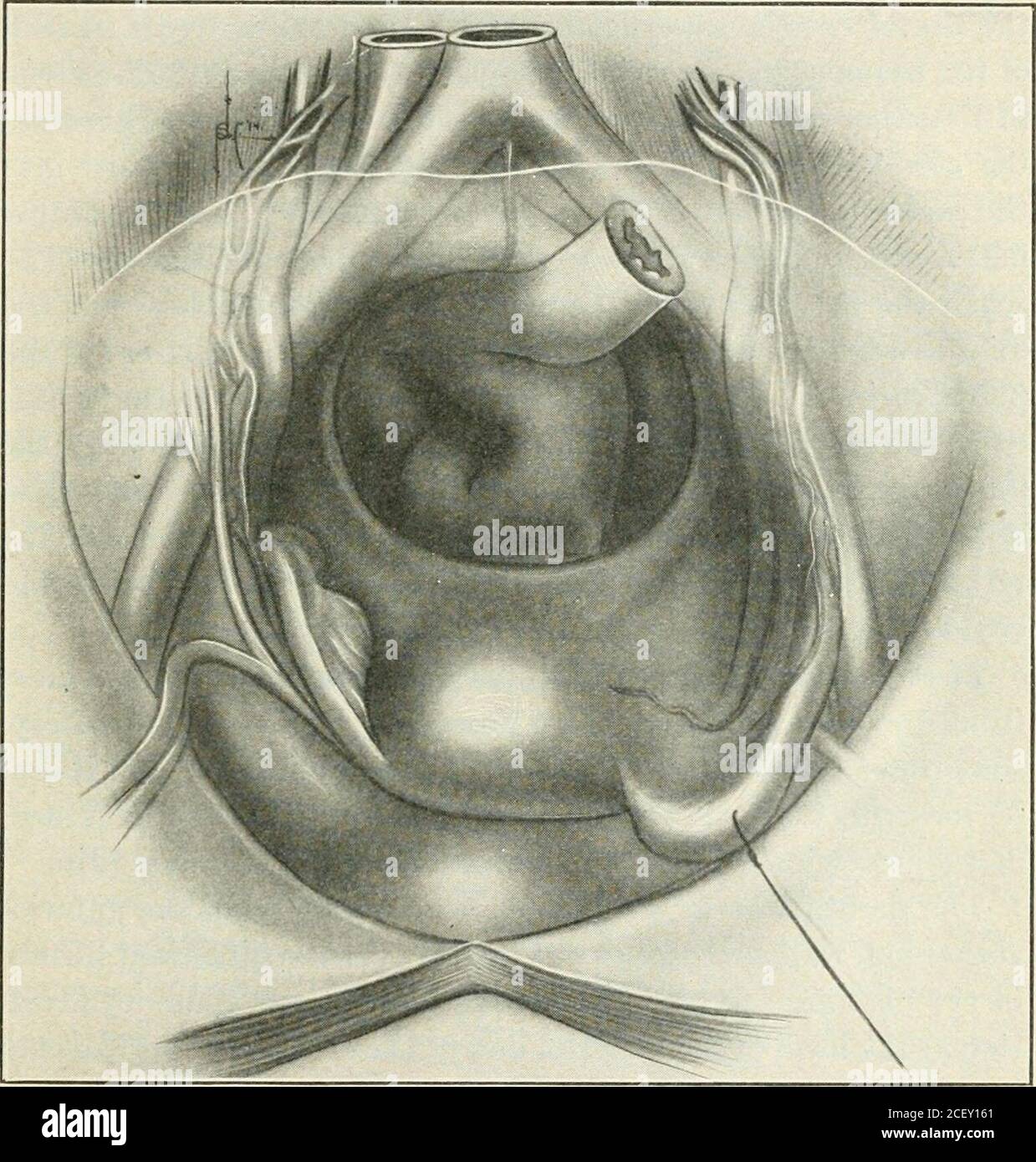 . Ein Handbuch der gynæcology- und Beckenchirurgie, für Studenten und Praktiker. es endet im Labium majus. An dieser Stelle wird die Basis des subkutanen Leistenrings (externer Leistenring) notiert. Äußerlich zum Pubic Tubercle und sich vom Leistenband (Pouparts Ligament) ausdehnend oberflächlich, um durch seinen tiefen oder posterioren Rand befestigt zu werden, ist das Lakunar Ligament (Gimbernats Ligament) dessen Apex am Pubic Tubercle ist, Seine Basis an der inneren Grenze des femoralen (cruural) Rings mit der femoralen Vene in enger Apposition.Wenn man weiter seitlich übergeht, überlappt sich der muskel ilio-psoas Stockfoto