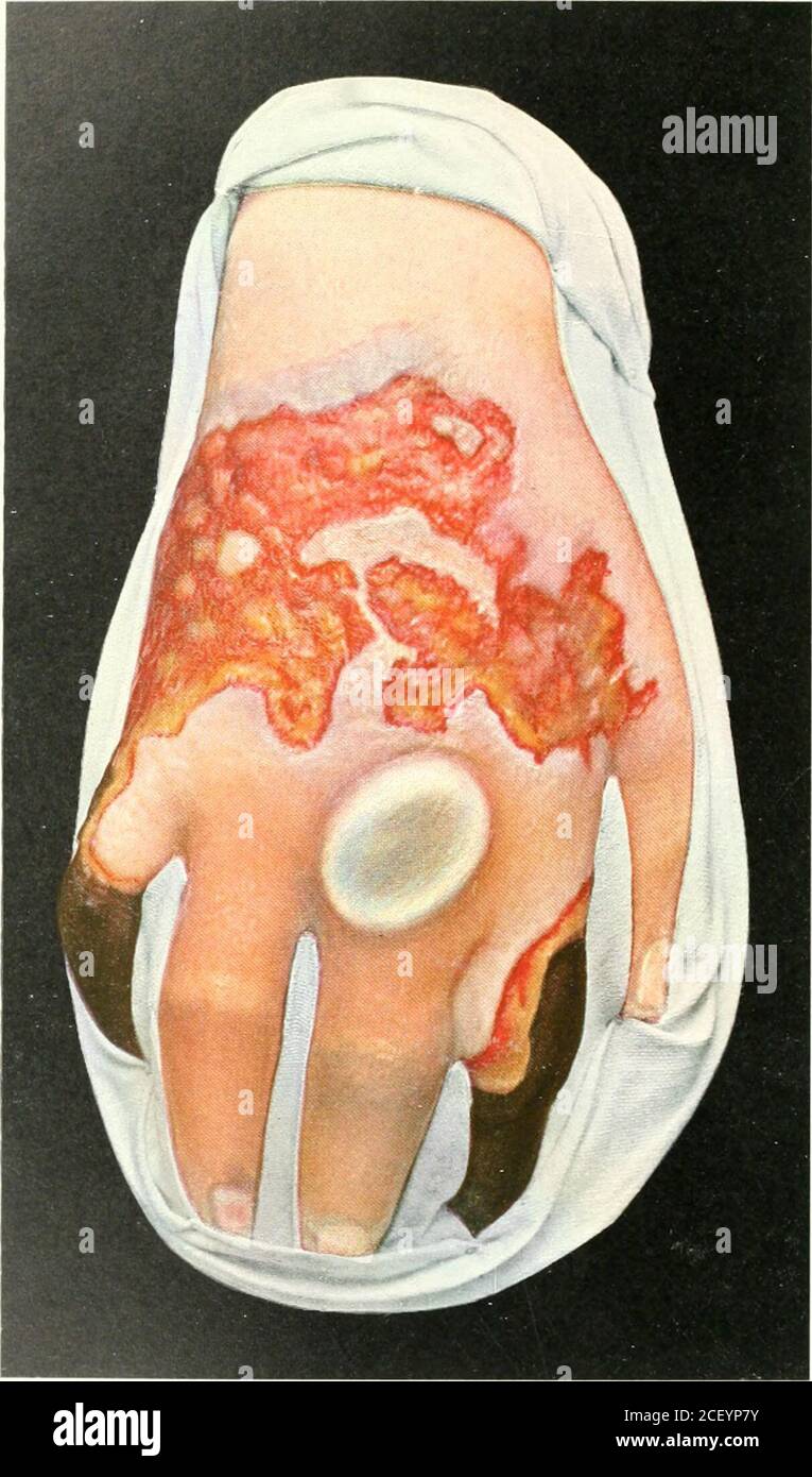 . Atlas der klinischen Chirurgie; mit besonderem Bezug auf Diagnose und Behandlung für Praktiker und Studenten. Abb. 135. Oangraena carbolica. Bockenheimer, Atlas. Registerkarte. CVM... Abb. 136. Combustio entheniatnsa - bullosa  escliarotica. Rcbman Company, Neve-York. COMBUSTIOERYTHEMATOSA-BULLOSA-ESCHAROTICA {Hums)Platte CVin, Abb. 136. Verbrennungen können durch die Wirkung von Strahlungswärme verursacht werden; z.B. längere Exposition gegenüber heißer Sonne oder einem heißen Feuer. Die Wärme kann durch Feststoffe, Flüssigkeiten oder Gase entstehen. Elektrik (Blitzschlag) und die Röntgenstrahlen können auch Verbrennungen verursachen; auch starke Säuren und Laugen (Schwefelsäure und Salpetersäure Stockfoto