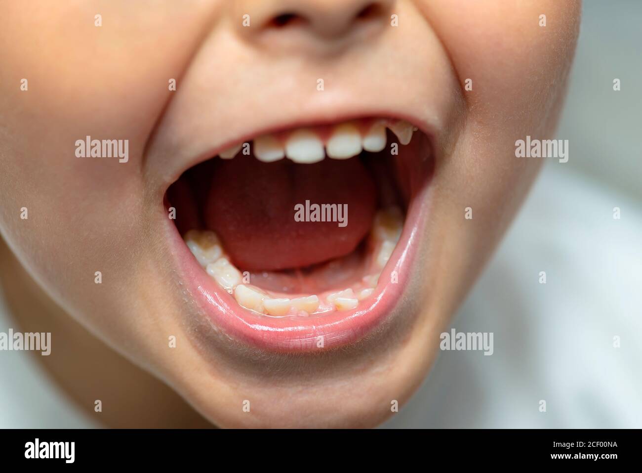 Lücke junge kind mund Fotos und Bildmaterial in hoher Auflösung Alamy