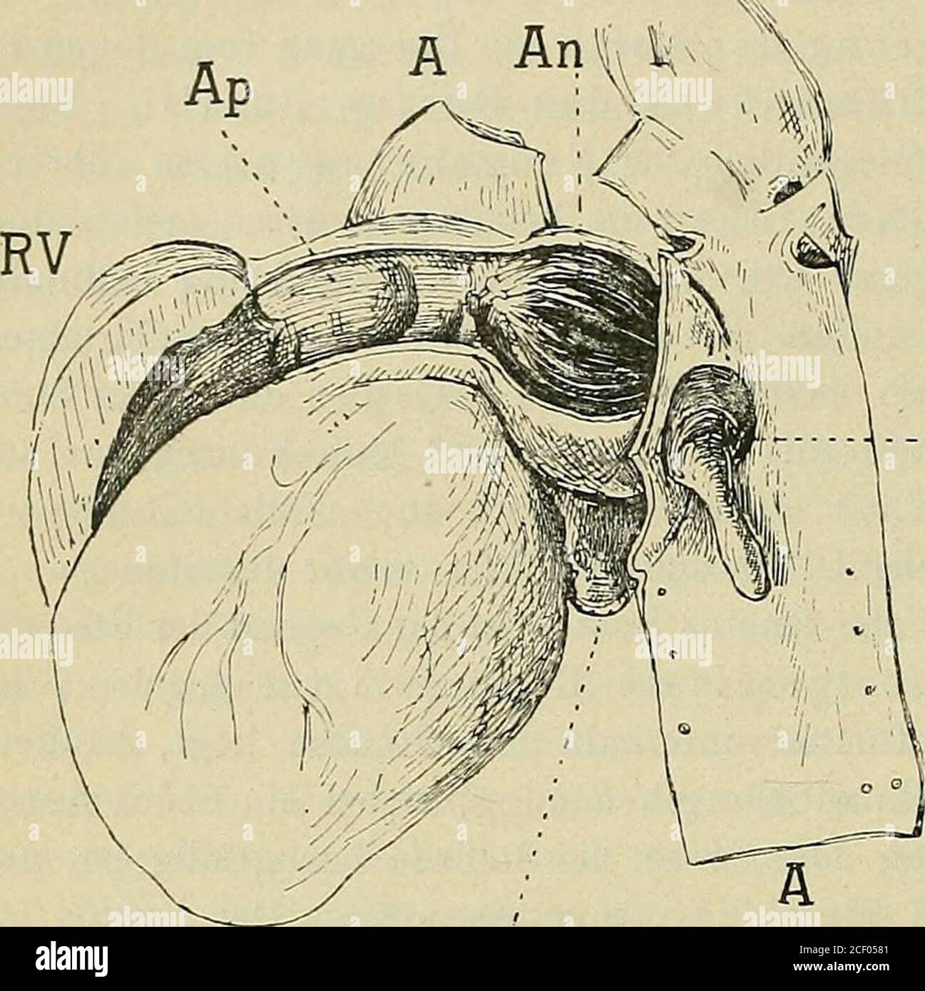 . Lehrbuch der speziellen pathologischen Anatomie fÃ¼r Studierende und Ãrzte. Ausgehen (RauchfuÃ). Alle Ã¼brigen angehobenen Anomalien der Form und Lage des Herzens haben im Vergleich zu den prochenen VerÃ¤Nderungen eine gerage Bedeutung und sind selten. Es wÃ¤ren zu nennen:Hypoplasie das Herz ist zu klein;reine idiopathische Hypertrophie ist zu GroÃ [in dem Falle vonSimmonds bei einem Neugeborenen44 g schwer, normal nach Thomabbeim Neugeborenen 20,6 g; in demFalle von Hedinger (lit.) bei einem15 monatlichen Art 132 g, normalnach Viererorden 44â47; in Verf. (C. f. Schw. 17, 19 Stockfoto