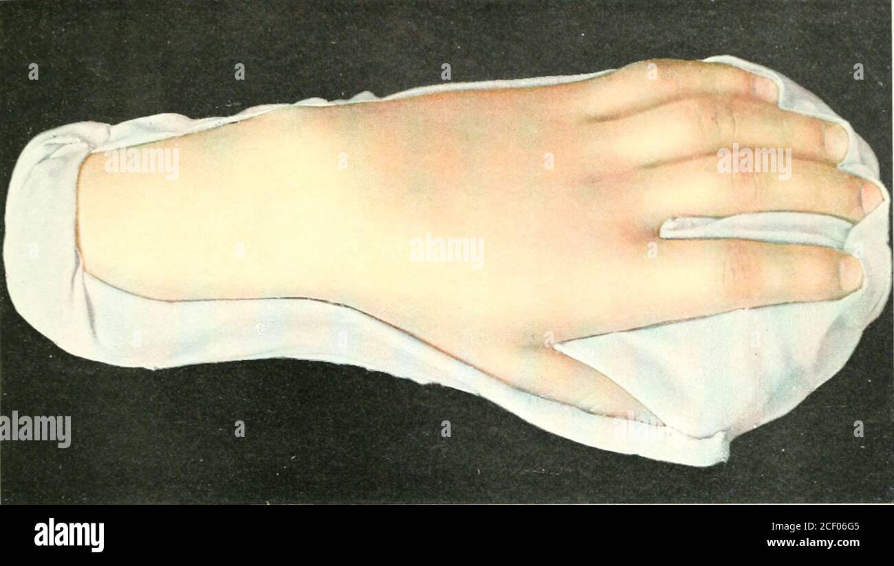 . Atlas der klinischen Chirurgie; mit besonderem Bezug auf Diagnose und Behandlung für Praktiker und Studenten. Zur Suppurierung der Sehnenscheide (vgl. Abb. L 93, S. Die Art der Läsion und die Tatsache, dass es keine Bewegungskraft im Finger gibt, zeigt, dass die Flexorsehne zerstört wird.Daher ist die Kontraktur sowohl dermatogen als auch tendenendogen, d.h. durch Kontraktion von Haut und Sehne verursacht. In Fällen, in denen die Sehne teilweise zerstört ist, oder sehr fest mit der hypertrophen cuta-neösen Narbe verbunden ist, ist die operative Behandlung nicht erfolgreich.nach der Entfernung der Narbe kommt es zu einer Kontraktur in t Stockfoto