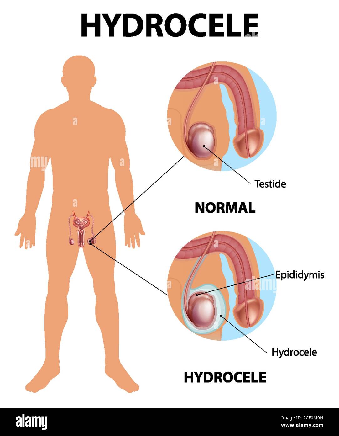 Medizinisches Poster zeigt verschiedene männliche normale Hoden und Hydrozele Abbildung Stock Vektor