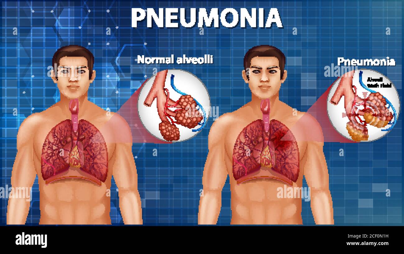 Vergleich von gesunden Alveolen und Lungenentzündung Illustration Stock Vektor