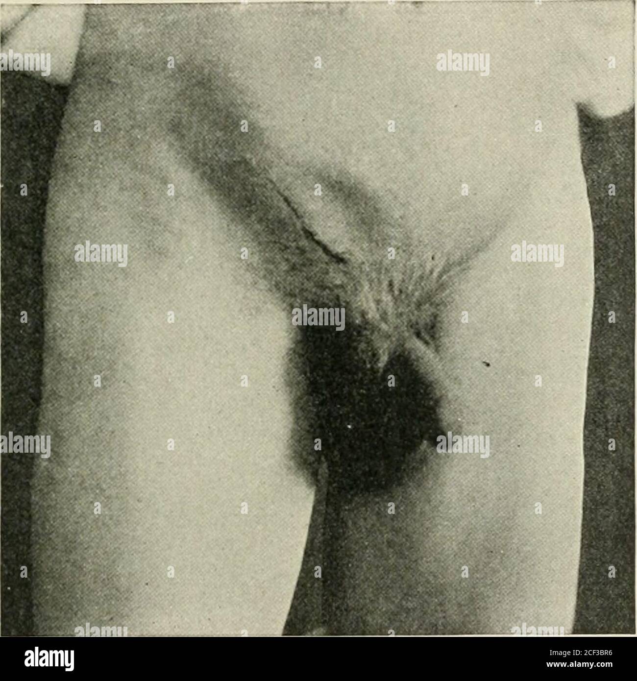 . Bauchhernie : seine Diagnose und Behandlung. Interstitielle Erbgut;i ninl ret.urn d li stu W- auf der rechten Seite in einem Mann von 25 Jahren. Rechte Seite des Hodensacks nidimentarj-. Hernialsack ioutid unter externem schrägen Muskel. Hodeninnendes äußeren Ringes. Ich wünschte, es klar verstanden, dass ich nicht getan habe, norfound es notwendig zu tun. Diese Operation der Platzierung der Hoden zwischen dem Peritoneum und der muskulären Wand des Bauches, auf jedem Voung Kind, aber ich bin überzeugt, dass es weit besser als Kastration ist, in erwachsenen Fällen. Wenn der Hoden kann so niedrig wie in dem Fall gezeigt, in Feigen niedergeschlagen werden. 134 Stockfoto