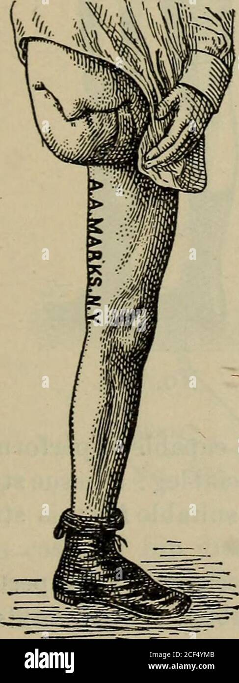 . Eine Abhandlung über künstliche Gliedmaßen mit Gummihänden und Füßen ... Nr. 538. Nr. 539. Nr. 537, ein ähnlicher Stumpf, aber eine Kleinigkeit länger. A. A. MARKS, KÜNSTLICHE LIMHS, NEW YORK CITY. 49 Nr. 538, ein langer und großer Oberschenkelstumpf mit einer Fülle von Gewebe an der Extremität, der Druck auf die Extremität ausüben kann. Nr. 539, ein Oberschenkelstumpf, der sich fast bis zum Knie erstreckt, die Extremitätenkonisch und zart. Nr. 540. Stockfoto