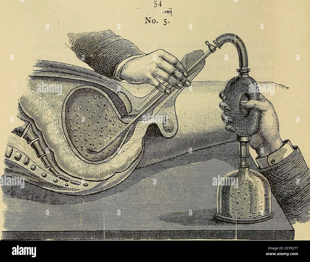 Erkrankungen der Blase und der Prostata und obskure Erkrankungen der  Harnorgane, mit Diagrammen, die die Behandlung des Autors von Stein, ohne  Schneiden, und zahlreiche erfolgreich behandelte Fälle mit der  Spray-Behandlung bisher