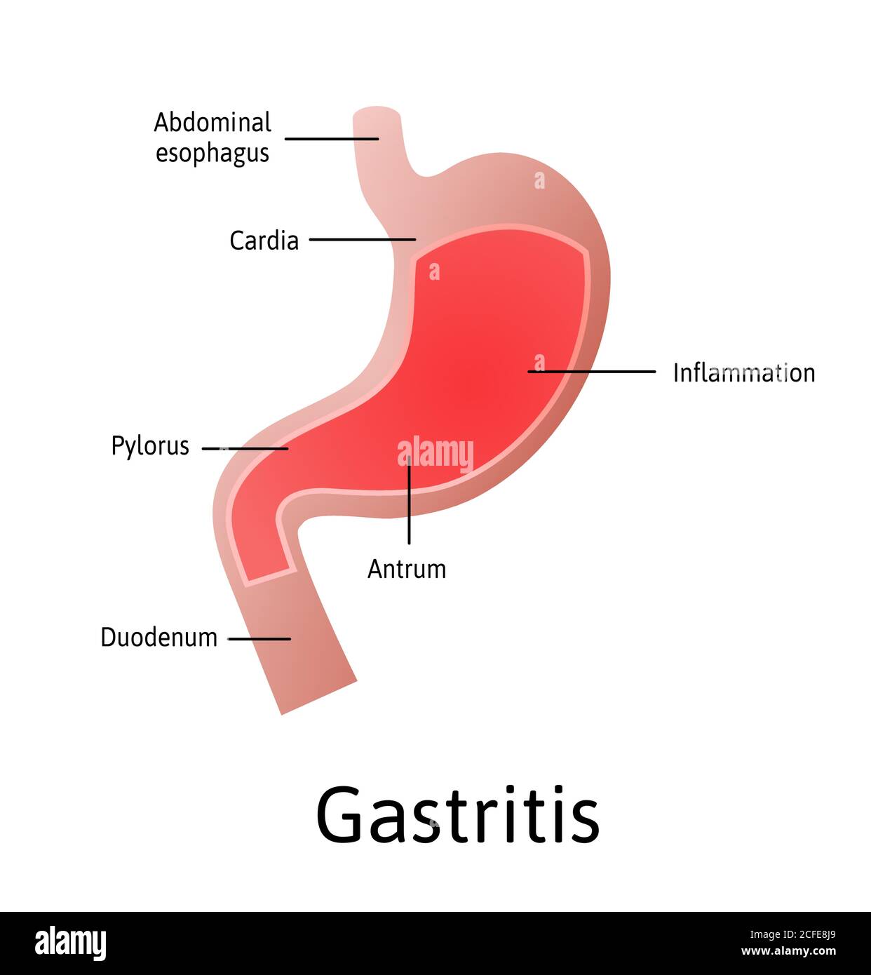 Gastritis, eine Entzündung, Reizung oder Erosion der Magenschleimhaut. Medizinische Vektordarstellung mit Linien gekennzeichnet. Alle Teile des Magens Stock Vektor
