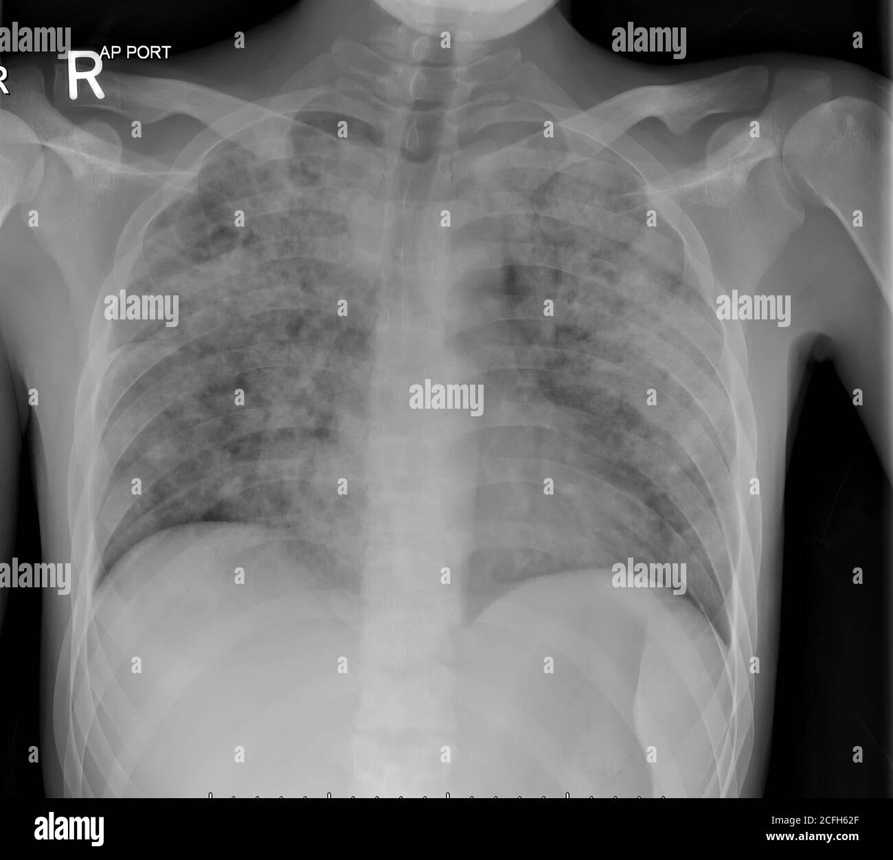 Röntgenaufnahme der Brust bei einem Patienten mit aktiver Lungentuberkulose (TB) mit Lungenentzündung und Kavitation, die in beiden Lungen gestreut sind. Stockfoto