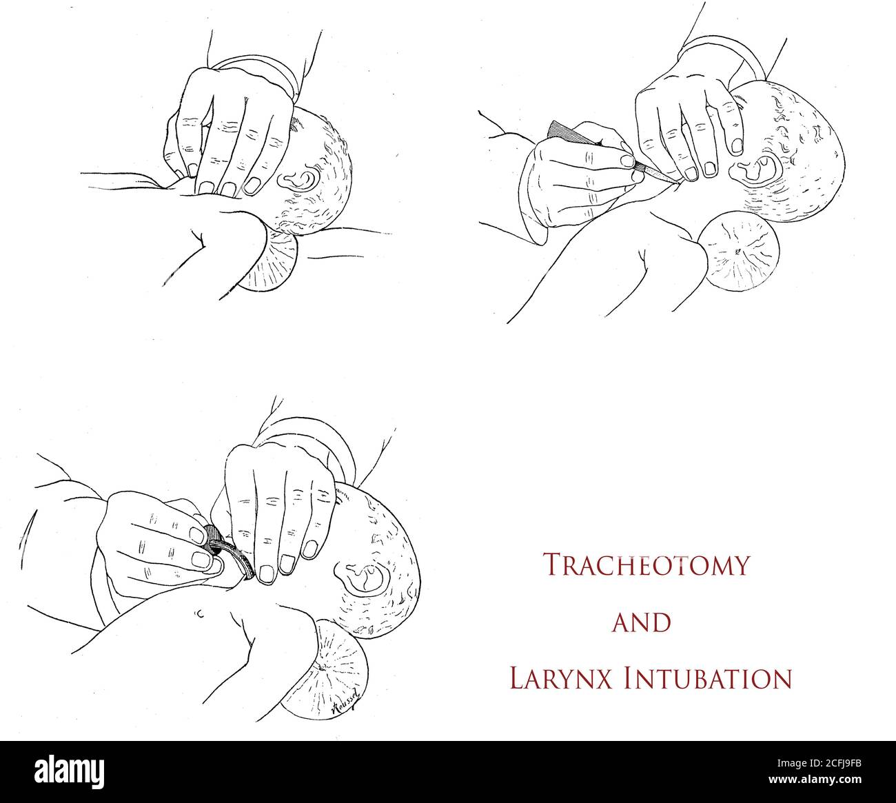 Gesundheitswesen und Medizin: Tracheotomie und Kehlkopfintubation, drei Schritte Zeichnungen erklären, wie die Notfalloperation durchzuführen Stockfoto