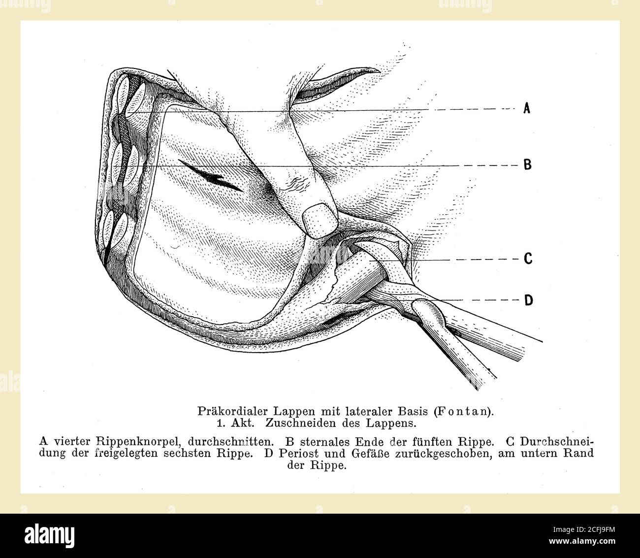 Gesundheitswesen und Medizin: Zeichnung, die erklärt, wie man einen Brustlappen-chirurgischen Schnitt mit deutschen Beschreibungen durchführt Stockfoto