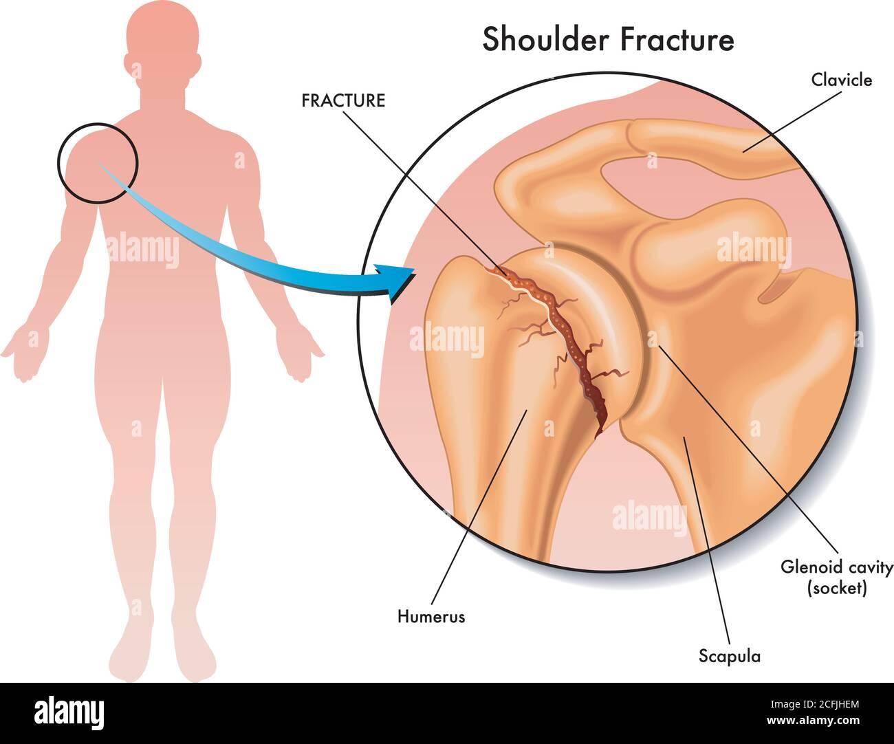 Medizinische Darstellung einer Schulterfraktur und ihrer Lage im menschlichen Körper, mit Anmerkungen. Stock Vektor