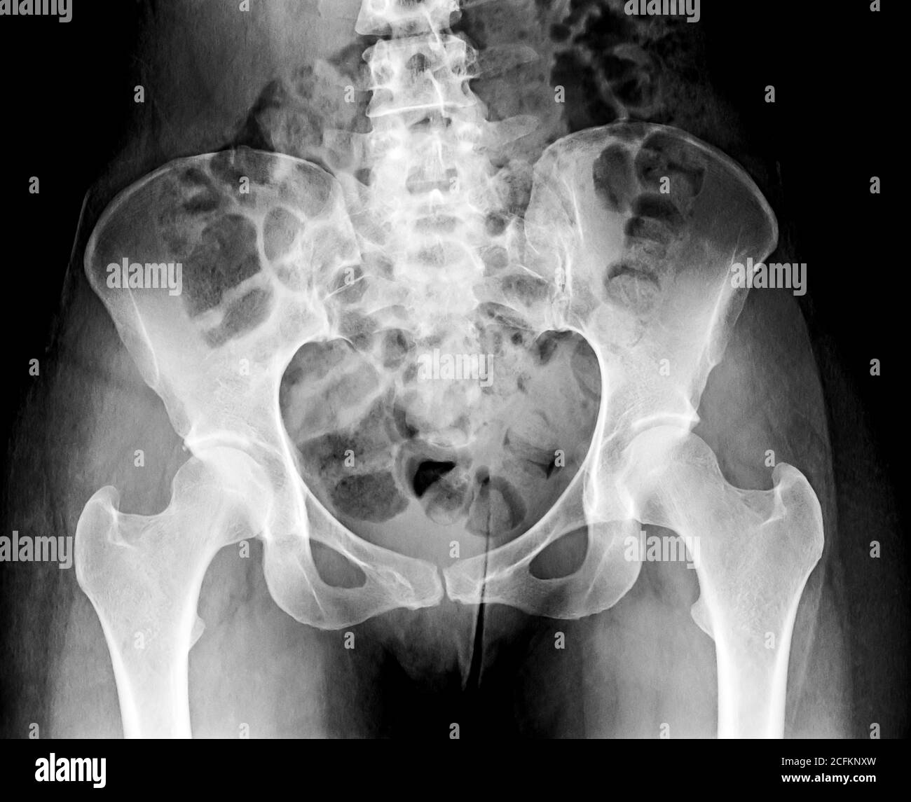Becken Röntgenaufnahme, menschliches Skelettbild. Stockfoto