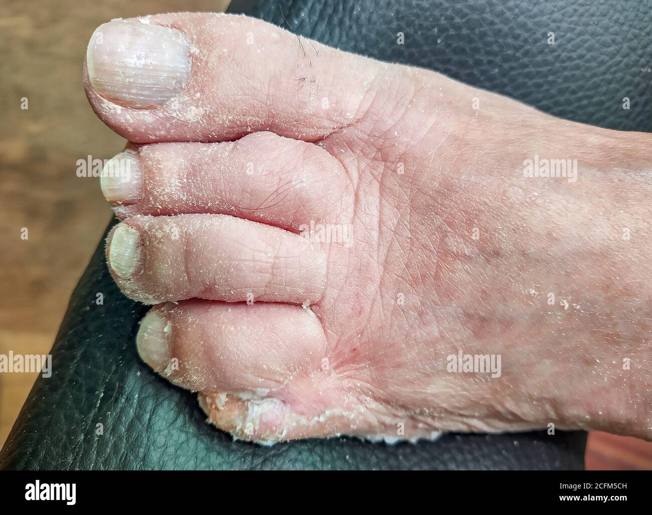 Fused Zehen nach einer erfolglosen Operation. Die Hauterkrankung bei der allergischen Dermatitis von der Reaktion auf den Honig. Fußbearbeitung, Pediküre. Stockfoto
