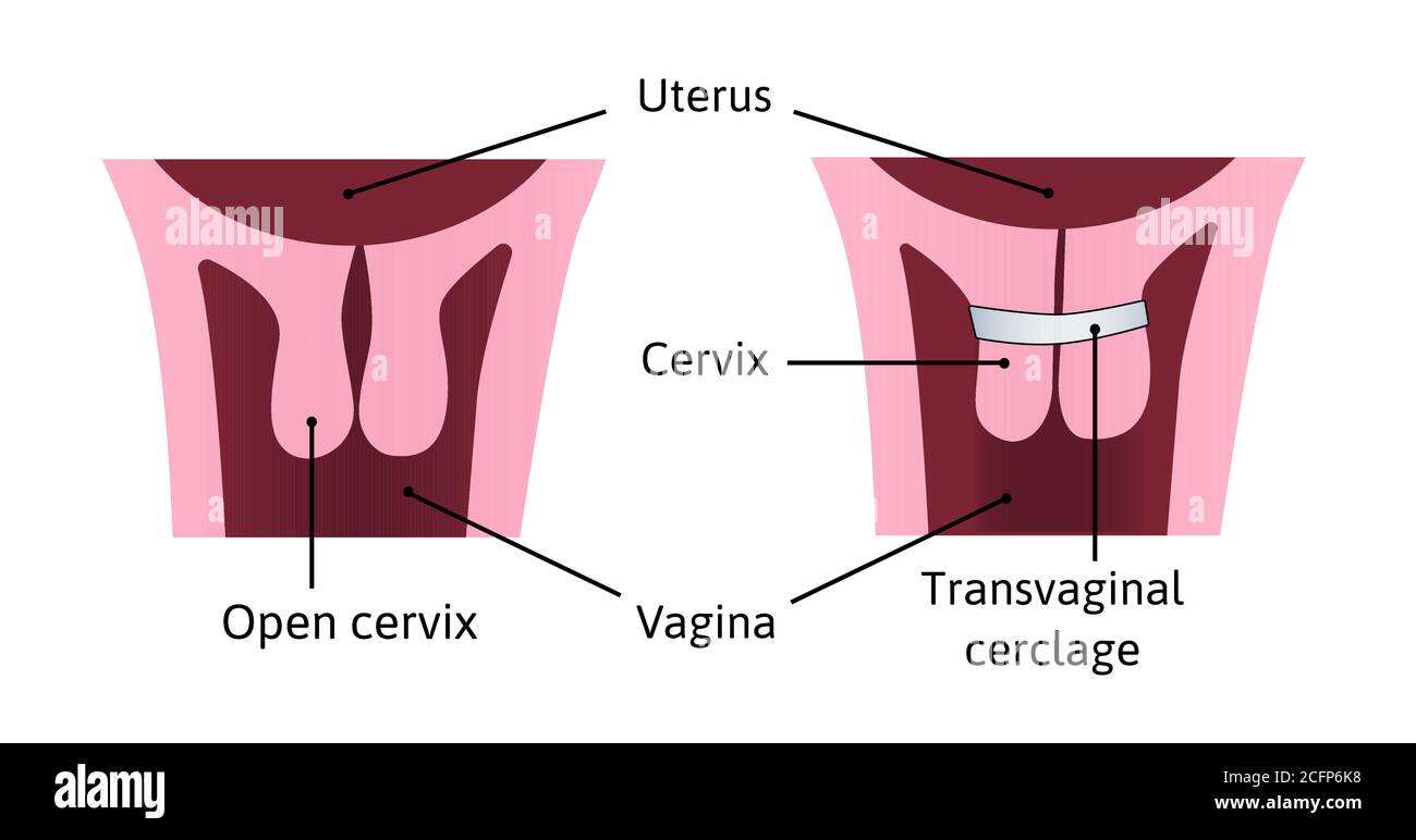 Zervixcerclage Verschärfung der zervikalen Öffnung während der Schwangerschaft. Problem, Verletzung. Gebärmutter mit offenem Gebärmutterhals und hellblauen Cerclage darauf. vektor Stock Vektor