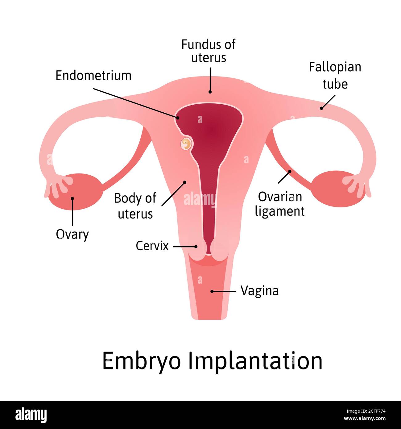 Implantation. Stadium der Schwangerschaft, wenn der Embryo an der Wand des Uterus haftet. Teile des Uterus sind mit Linien markiert. Vektorgrafik für medizinische Zwecke. Stock Vektor