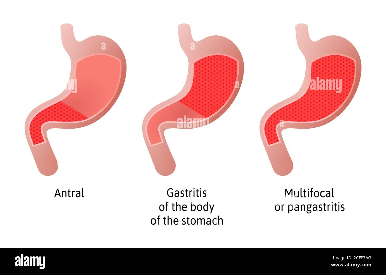 Lage der Gastritis, eine Entzündung der Magenschleimhaut. Drei Typen antral, des Körpers und Pangastritis. Medizinische Vektordarstellung Stock Vektor