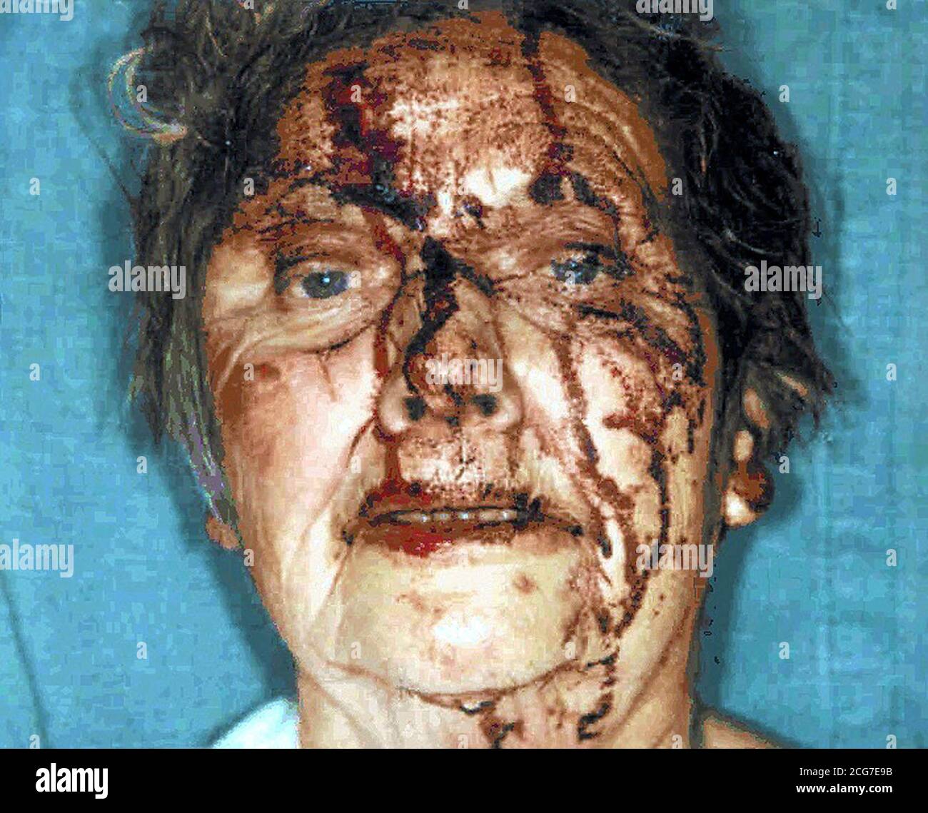 WARING GRAFIKINHALT : Cambridgeshire Polizei undated Sammeln Sie Foto von 81-jähriger Freda Cook, nachdem sie angegriffen wurde. Frau Cook erlitt bei dem Angriff in ihrem Haus in Shelford Bottom, Cambs, am frühen Montag Kopf- und Schulterverletzungen. * Detektive haben den Angriff als schrecklich beschrieben und sagen, dass jemand ihre Angreifer kennen muss. Freda, eine Pflanzenzüchterin, die allein lebt, sprach heute nach zwei Tagen im Krankenhaus mit Reportern in Cambridge zum ersten Mal über den Angriff. Stockfoto