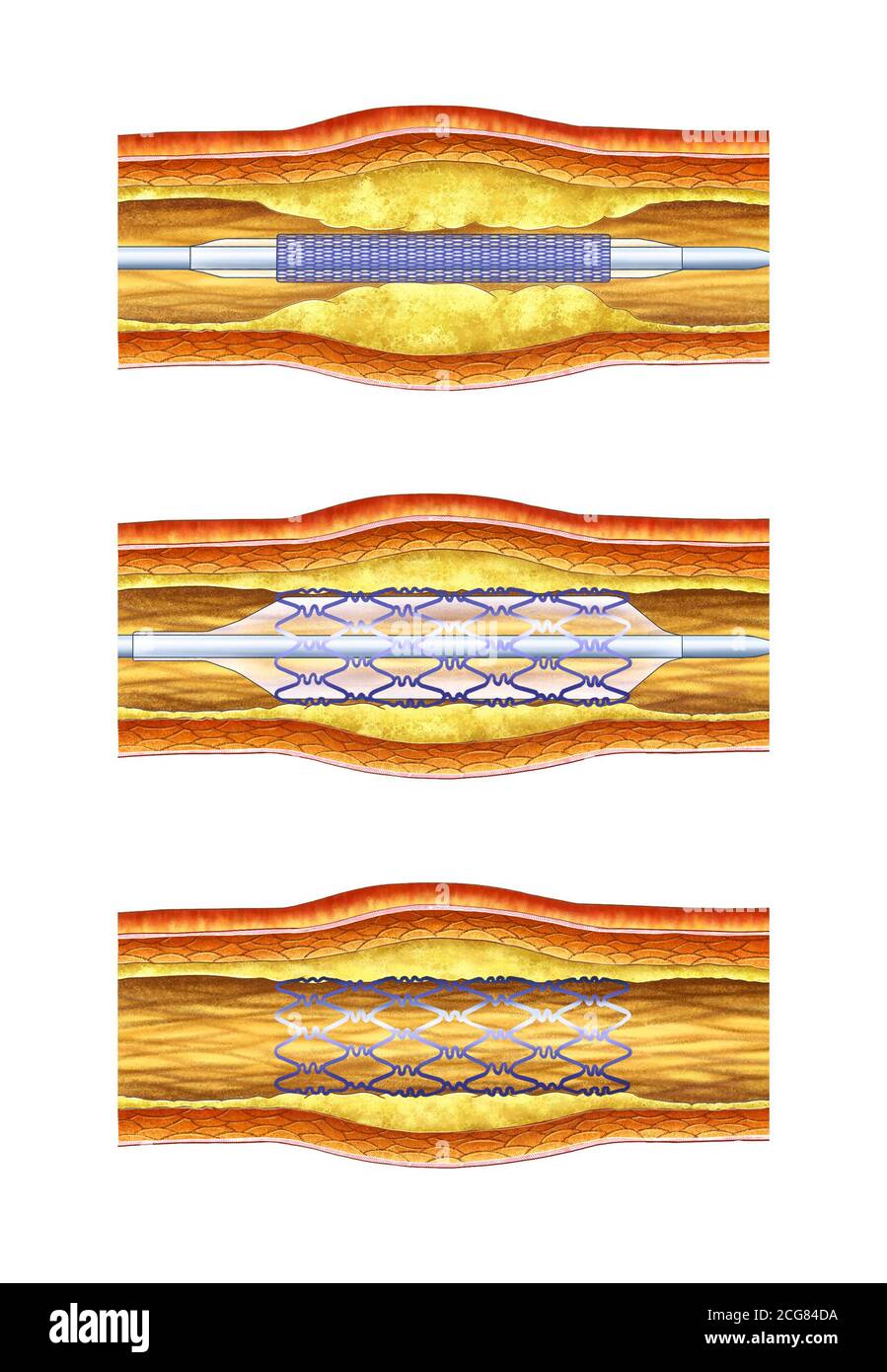Anatomische Darstellung des vaskulären Stent-Verfahrens Stockfoto