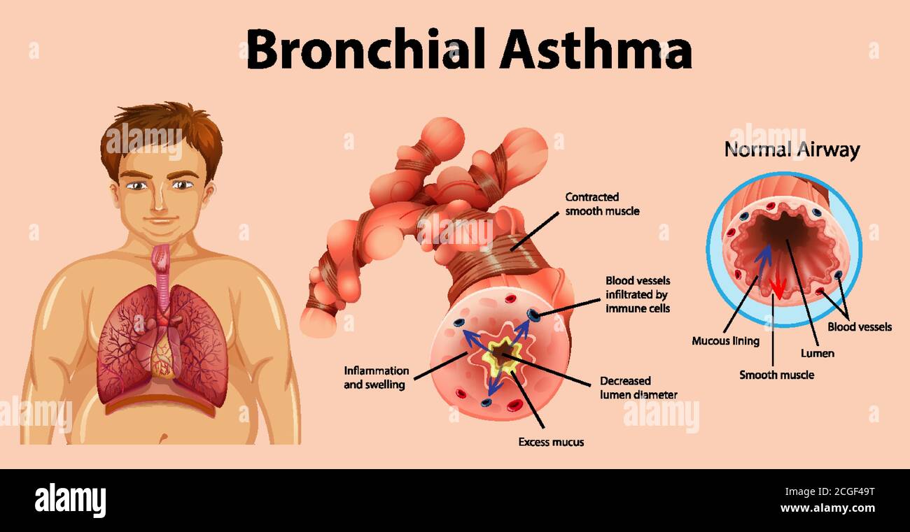 Illustration: Asthma entzündete Bronchien Stock Vektor