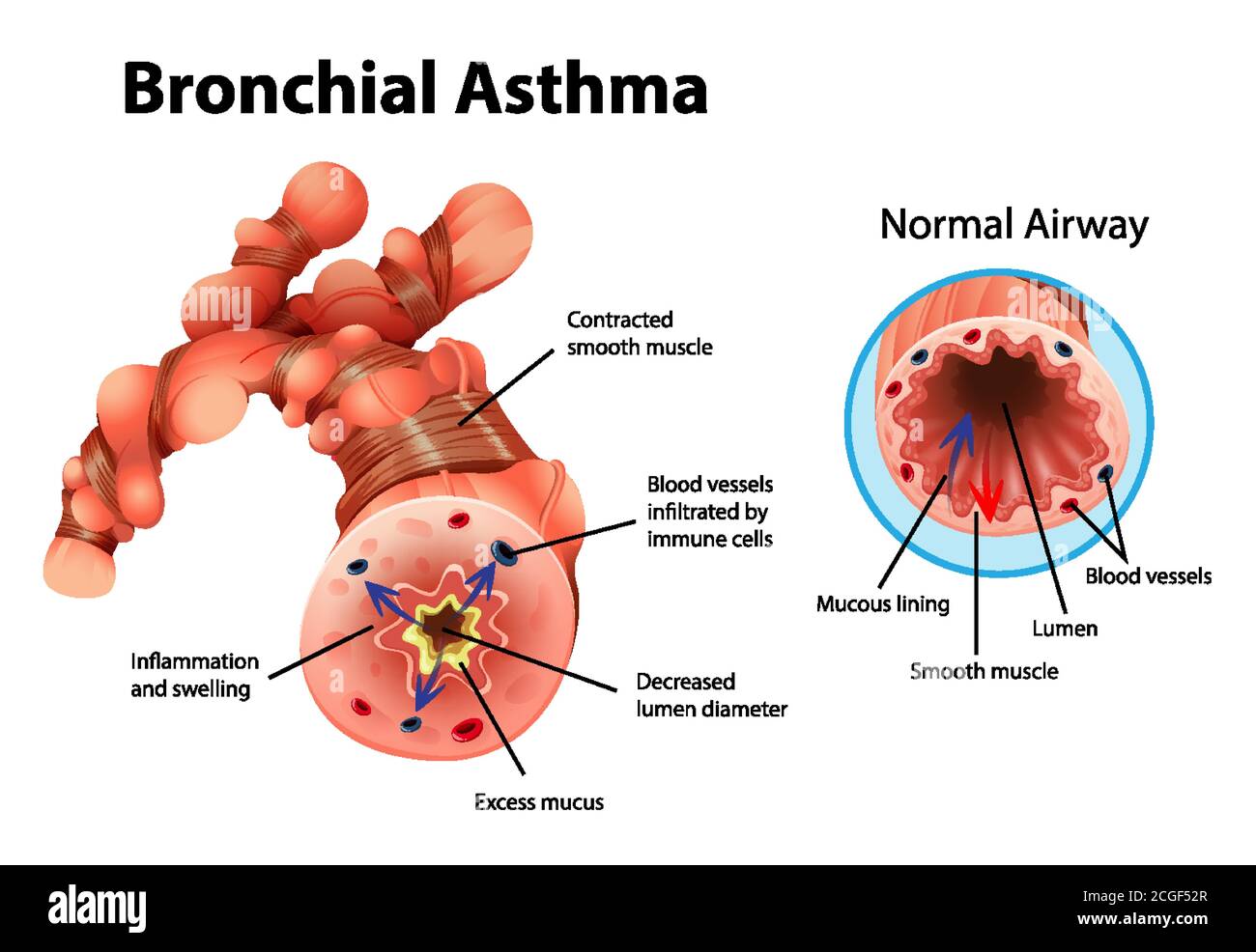 Illustration: Asthma entzündete Bronchien Stock Vektor