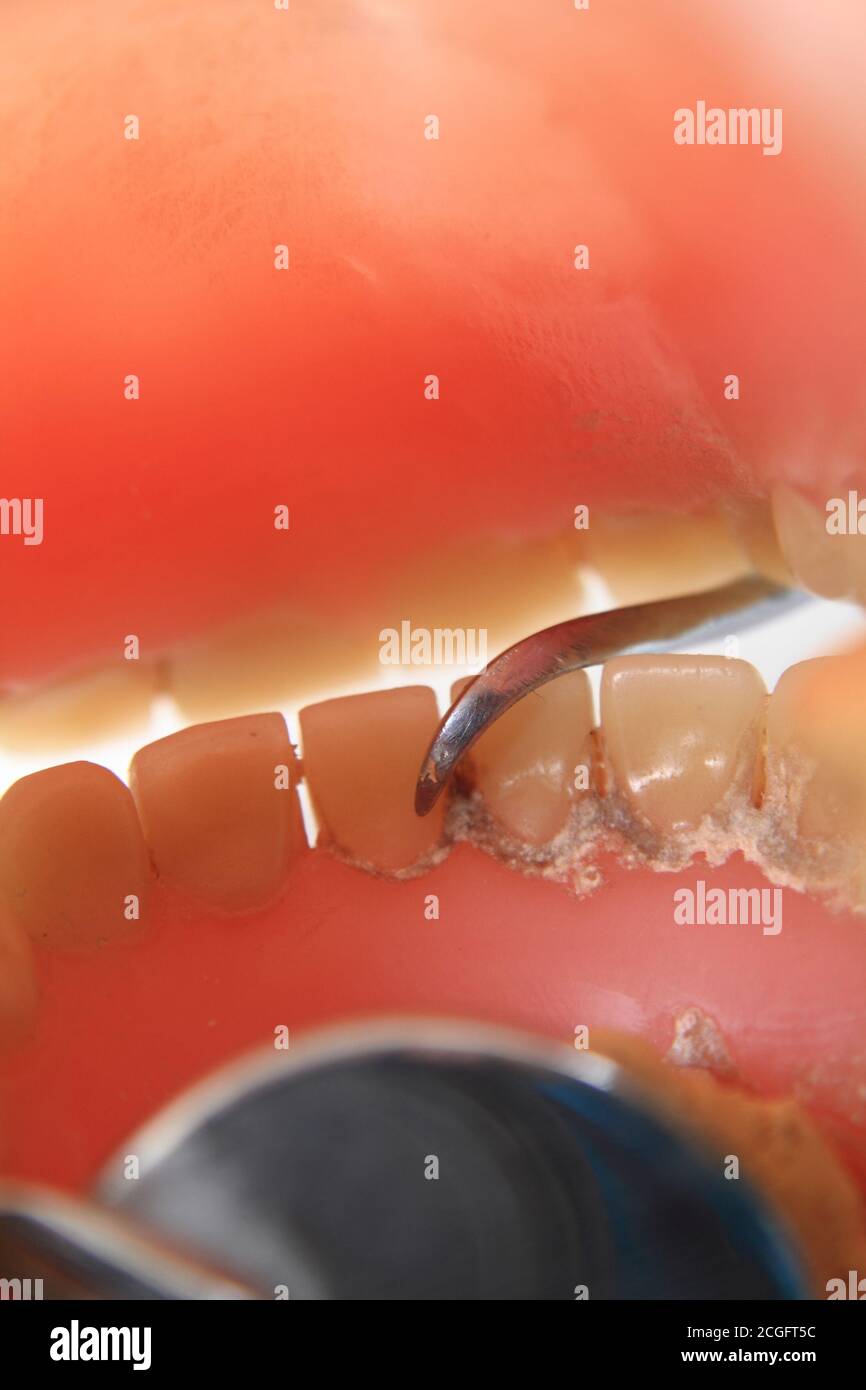 Detail der zahnärztlichen Problem als besonderen Hintergrund Stockfoto