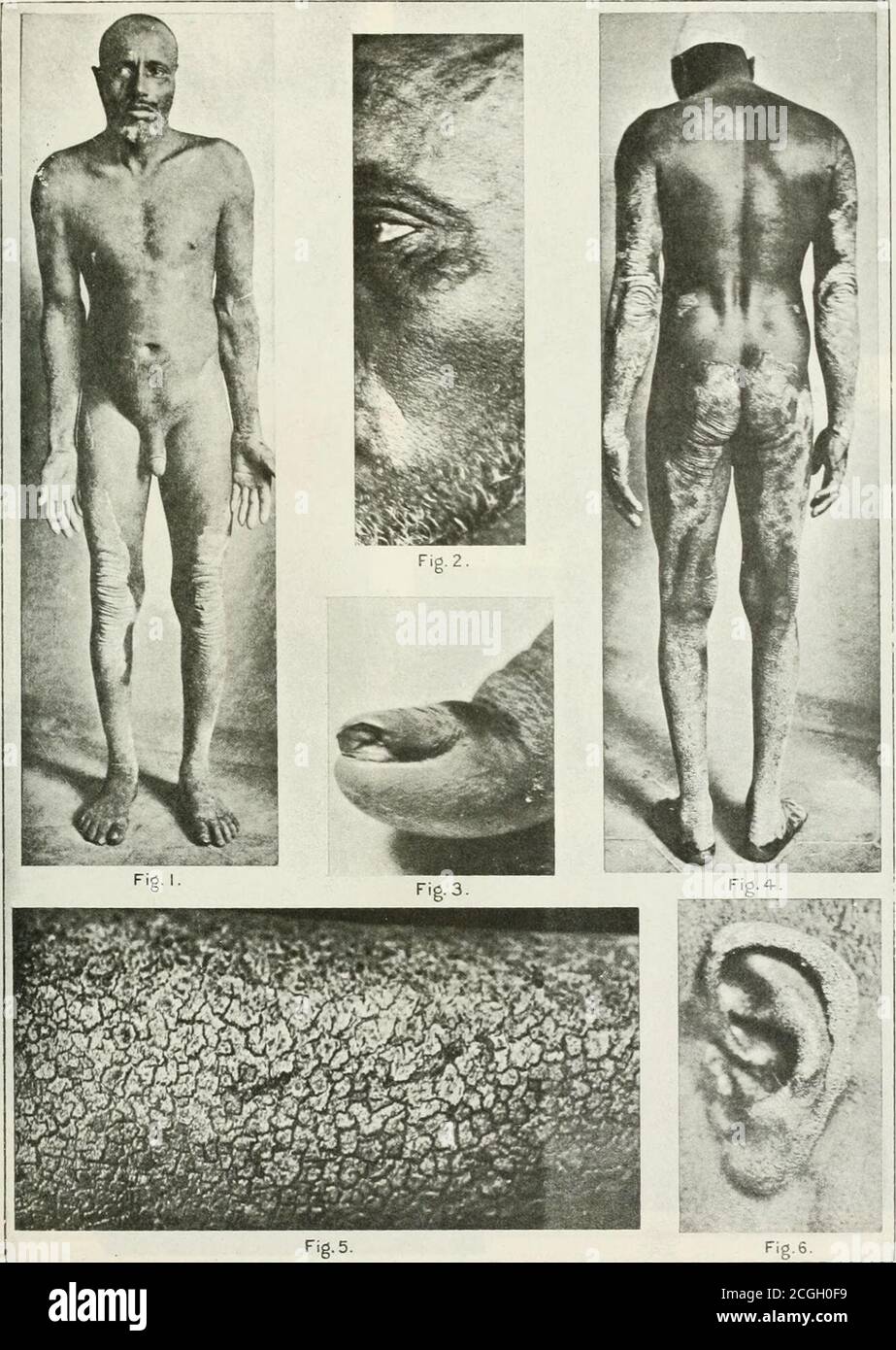 . Das Journal of Tropical Medicine and Hygiene . ll gesehen werden, um nicht ganz normal. Wenn nun diese Zahlen (17 und 18) mit einer Linse sorgfältig untersucht werden, wird festgestellt, dass es eine sehr ausgeprägte Hyperkeratose gibt, Und dass, obwohl es einige Akanthose gegeben hat, wie durch die zellulären Vertiefungen in die Cutis und durch die länglichen verdrehten und unterteilten Formen der Papillen belegt wird, gibt es noch keine markante allgemeine Verdickungnf die rete Malpighii, Und es wird durchaus beweisend sein, daß es keine Spur von entweder dem Stratum lucidumor von Stratum granulosum gibt. Die Feinheit der Therete über den Apices von Th Stockfoto