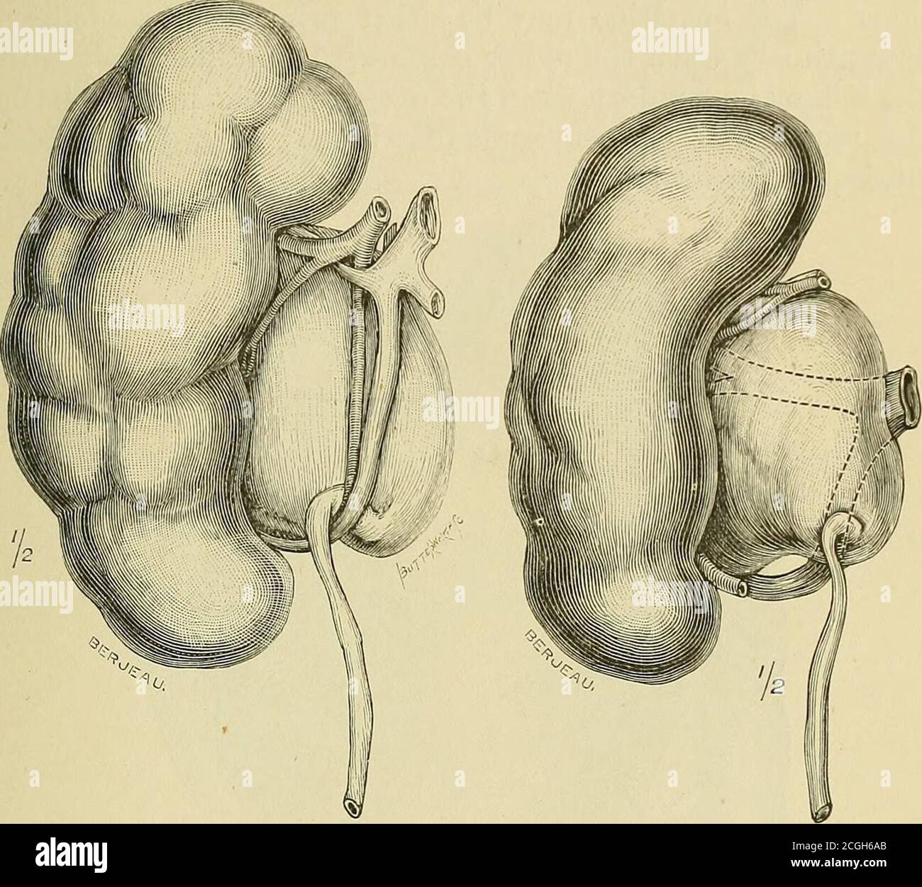Nephrektomie Fotos und Bildmaterial in hoher Auflösung Alamy