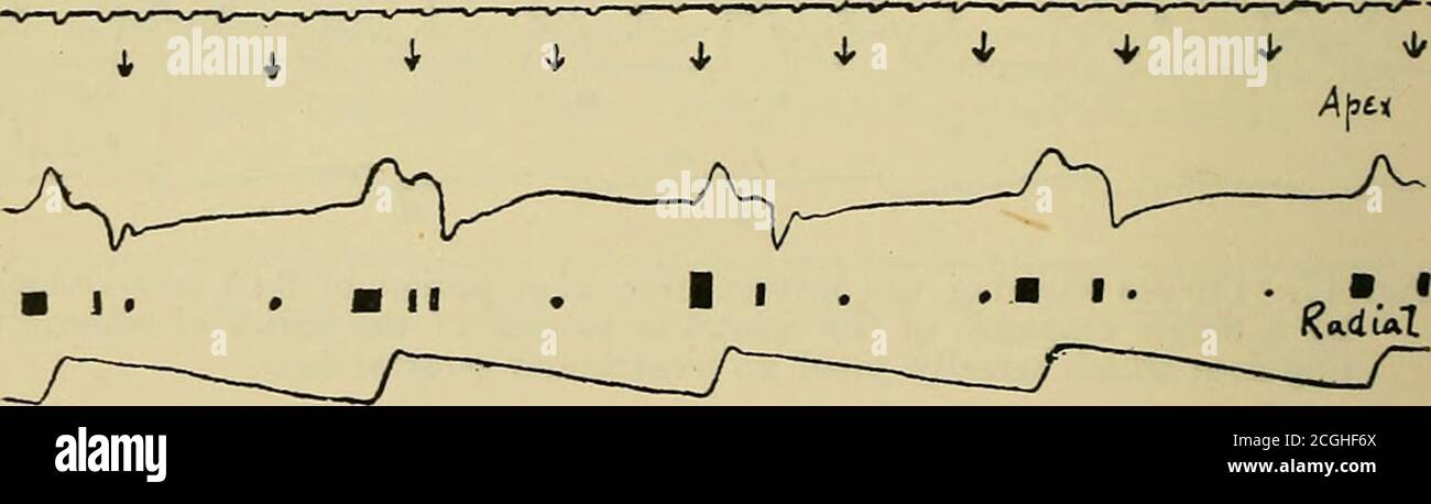. Klinische Störungen des Herzschlags: Ein Handbuch für Praktiker und Studenten. Abb. 18. Arterielle und Scheitelkurven aus einem Fall von Mitralstenose, während der Mechanismus von einem Zustand der abgeworfenen Schläge zu 2 : 1 Herzblock übergeht.Beachten Sie die Anordnung der diastolischen Murmeln und ihre Abhängigkeit von jenen aurikulären Kontraktionen, die Blut in den Ventrikel zwingen.. Abb. 19. Apex- und Radialkurven bei einem kompletten Herzblock. Die Herzgeräusche werden durch die aurikulären Kontraktionen modifiziert, die leicht hörbar sind. Wo aurikuläre und ventrikuläre Kontraktionen den ersten Ton i begintogether Stockfoto