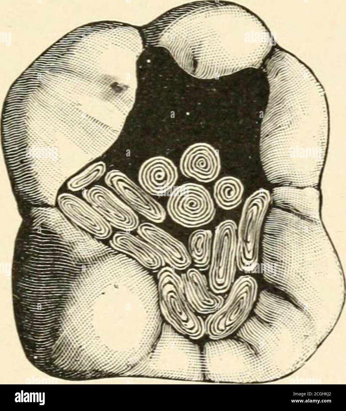 . Zinnfolie und ihre Kombinationen zum Füllen von Zähnen . yer uponlayer, – wie er es ausdrückte, zerschlug es. Auf diese Weise machte er Zinnfüllungen, die mehr als dreißig Jahre dauerten. 1839 füllte Dr. Corydon Palmer Zähne mit Tinfoil aus, auch Hohlräume mit Gold auskleideten und die Remainder mit Zinn füllte. Im selben Jahr füllte er die Kronen-(okklusalen)-Hohlräume zur Hälfte mit Zinn und zur anderen Hälfte mit Gold, so dass beide Metalle die Oberfläche erreichen konnten, auf dem gleichen Plan, auf dem viele proxymale Hohlräume jetzt gefüllt sind. (Siehe Abb. 3, zeigt etwa die Hälfte der Kavität fast fertig mit Zinnflaschen. Der gleiche Plan Stockfoto