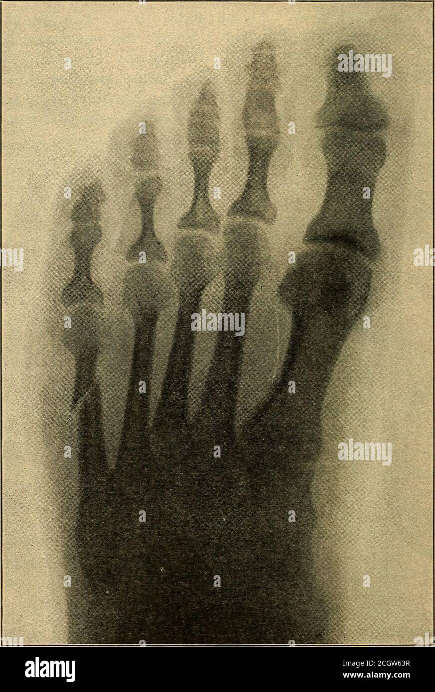 . Atlas und Inbegriff von traumatisch . Abb. 156. – Bruch des zweiten Metatarsalbones. Skiagraph von einem Seemann zwanzig Jahre verkauft verletzt in Marschieren. Typischer Hüttenfuß. Transversale Fraktur etwa in der Mitte des zweiten Metatarsals, mit seitlichem Versetzen. Die Diagnose konnte nur mit Hilfe der Rontgenstrahlen gestellt werden. 340 FRAKTUREN UND VERRAUSUNGEN.. Abb. 157. – Bruch des fünften Mittelfußknochens (Röntgen). Fielitz, männlich, 24 Jahre alt. Die Verletzung wurde durch ein sehr schweres Eisenstück verursacht, das auf den Fuß fiel. Es handelt sich also um eine direkte Fraktur oder eine Brech-Fraktur beider Phalanges Stockfoto