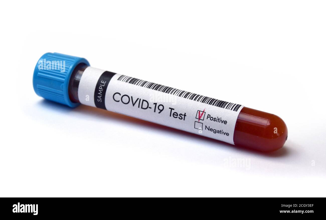 Teströhrchen mit Coronavirus-Testblutprobe positives Ergebnis auf Weiß Hintergrund Stockfoto