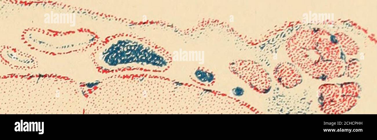 . Die Krankheiten der Kindheit und Kindheit . Deckglas Fleck der durch LumbarPunktion gewonnenen sedimented Fluid bei epidemischer Hirnhautentzündung. Polymorphonukleäre Zytologie; Vakuolisierung der Leukozyten und Lymphozyten; eigentümliche Konformation der Zellkerne; große Zellen, die lym-Phozyten ähneln; Diploeoeeus meningitidis im Zellkörper der Leukozyten* und außerhalb der Zellkörper in kleinerer TAUBPLATTE XVII M. Stockfoto