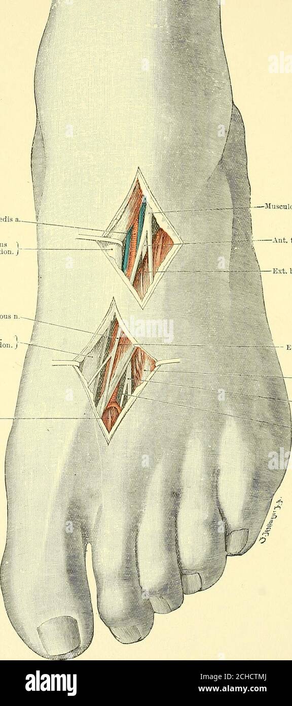 . Textbuch der operativen Chirurgie . FLG 134 -(1) Ligatiire der Arteria peronealis im oberen Teil. (2) das gleiche in seinem unteren Teil. (3) Exposureof externa! Nervus saphena. (4) Exposition von posterioren Tibia- und muskulo-kutanen Nervenzellen unterhalb des äußeren Tibia-Kondyls. (5) Exposition des muskulo-kutanen Nervus m die Mitte des Beins. (6) das gleiche im unteren Drittel, wo es durchdringt die fascia. J Ext. Longus 1hallucis Sehne. j Jlusculo-kutan n Ext. Lang. 1 Ihallucis Sehne. j ist dorsal  interossär. /. – Musculo-cutanaeons n. ANT. Tibial n. -^» - Ext. Brevis hallucis m. E Stockfoto