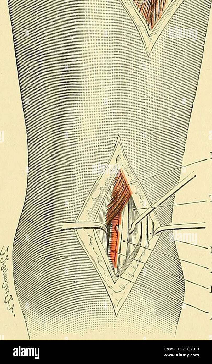 . Textbuch der operativen Chirurgie . 263 , , Tibialis anticus m. - Ext. LonRus digitorum m. – Vorderer Rand der Tibia.. Tibialis anticus m, Ant. Tibialis n. ^^ – Ant. Tibial a.^Ext. Longus hallncis m. Ext. Longus hallucis m. Sehne ext. Longus digitorum m. Jlusculo-kutane n.Ant. Tibial n.Dorsalis pedis a.. ^ Ant. Ringligt. Abb. 133. – Nervus A. tibialis anterior aud. 204 OPERATIVE OPERATION in der Sohle. Ein Einschnitt wird in einer Liue von Tlie Point der Lieel zu Tlie greattoe, beginnend vor dem Ball der Tbe Ferse und nach vorne ausdehnenden gemacht. Die Haut, die Hautschicht des Fettes und der dichte Logi Stockfoto