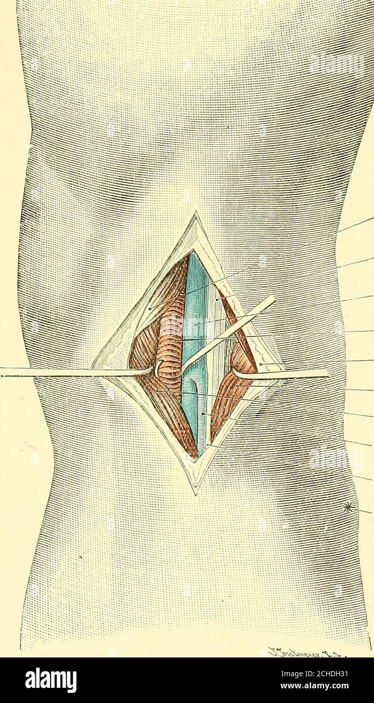 . Textbuch der operativen Chirurgie . der Nervus nal poplitea ist die