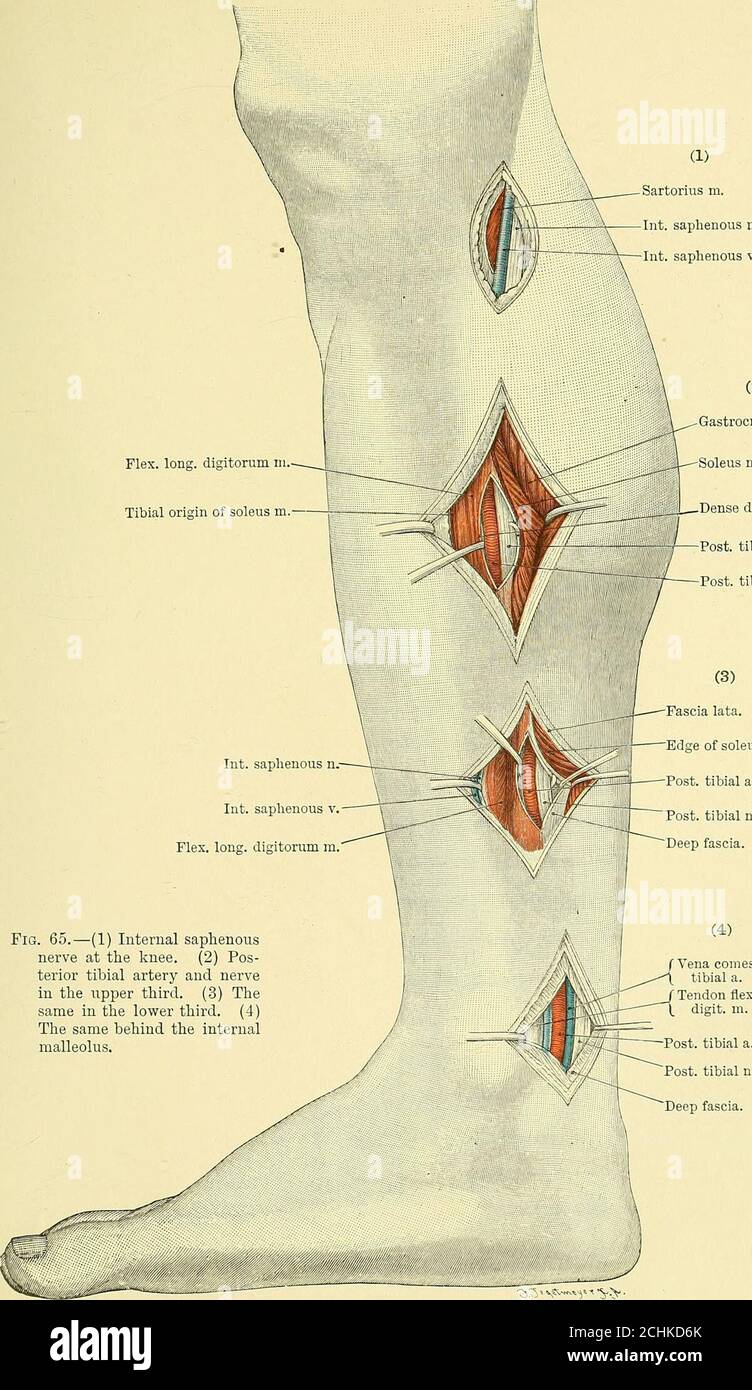 . Text-Buch der operativen Chirurgie . r Innerer Kopf von gastrocnemius m. Abb. 64. – Ligatur der hinteren tibialen Arterie über dem Origiu des Perus. Digitorum, die in der zuvor erwähnten Reihenfolge rückwärts liegen. Hinter dem Herzzahn befindet sich der große hintere Tibialnerv, dahinter wiederum die Sehne des flexorlongus haucis. Bei dieser Operation ist darauf zu achten, nicht zwischen den Lymg m vor dem tendo Achilis hineinzugelangen. OPERATION DER GROSSEN ARTERIEN 153 (1) Sartorius m.Int. saplienous n.Int. saphena v. Flex. Lang, digitorum inTibiale Herkunft des Soleus m. (2) gastrocnemius m. ■X- Soleus Stockfoto