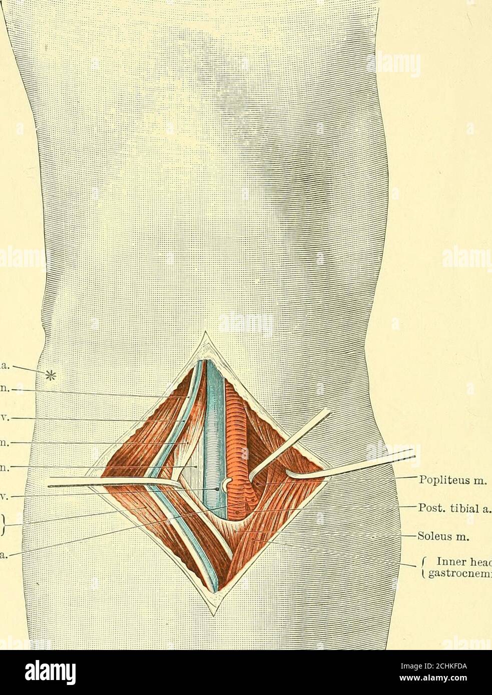 . Text-Buch der operativen Chirurgie . und nach hinten gezogen, wenn die Sehne des Flexor longus digitorum (mit seinen Muskelfasern dahinter) auf der Tibia liegend zu sehen ist. Bei der Teilung der dünnen Faszie, die die Deepflexoren bedeckt, befindet sich die Arterie unmittelbar darunter zur Außenseite des flexorlongus digitorum. Der hintere Tibialnerv liegt noch äußerer. Hinter dem inneren Malleolus. Die Inzision erfolgt in der Mitte zwischen der hinteren ^ der Teil der Arterie zwischen dem Ursprung der vorderen Tibia und der peronealen Arterie oughtto besitzen einen unverwechselbaren Namen. 152 OPERATIVE SURG Stockfoto