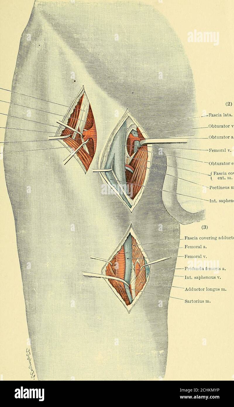 . Text-Buch der operativen Chirurgie . Ligaturing der femoralen Arterie, die Faszie über dem Adductor longus wird internalto die femoralen Gefäße geteilt, Und die Dissektion wird tief entlang der Fasern des Adductor longus zum Knochen hin fortgesetzt, bis zum inneren Aspekt des Vastus internus, dessen Fasern schräg nach unten und nach vorne übergehen. Die Arterie befindet sich an der hinteren anliegenden Kante des Vastus internus unmittelbar oberhalb des oberen Endes Insertions des Adductor longus, unter dem sie nach unten fortgesetzt wird. 73. Ligatur der Arteria circumflex externa. (A) an seinem oder Stockfoto